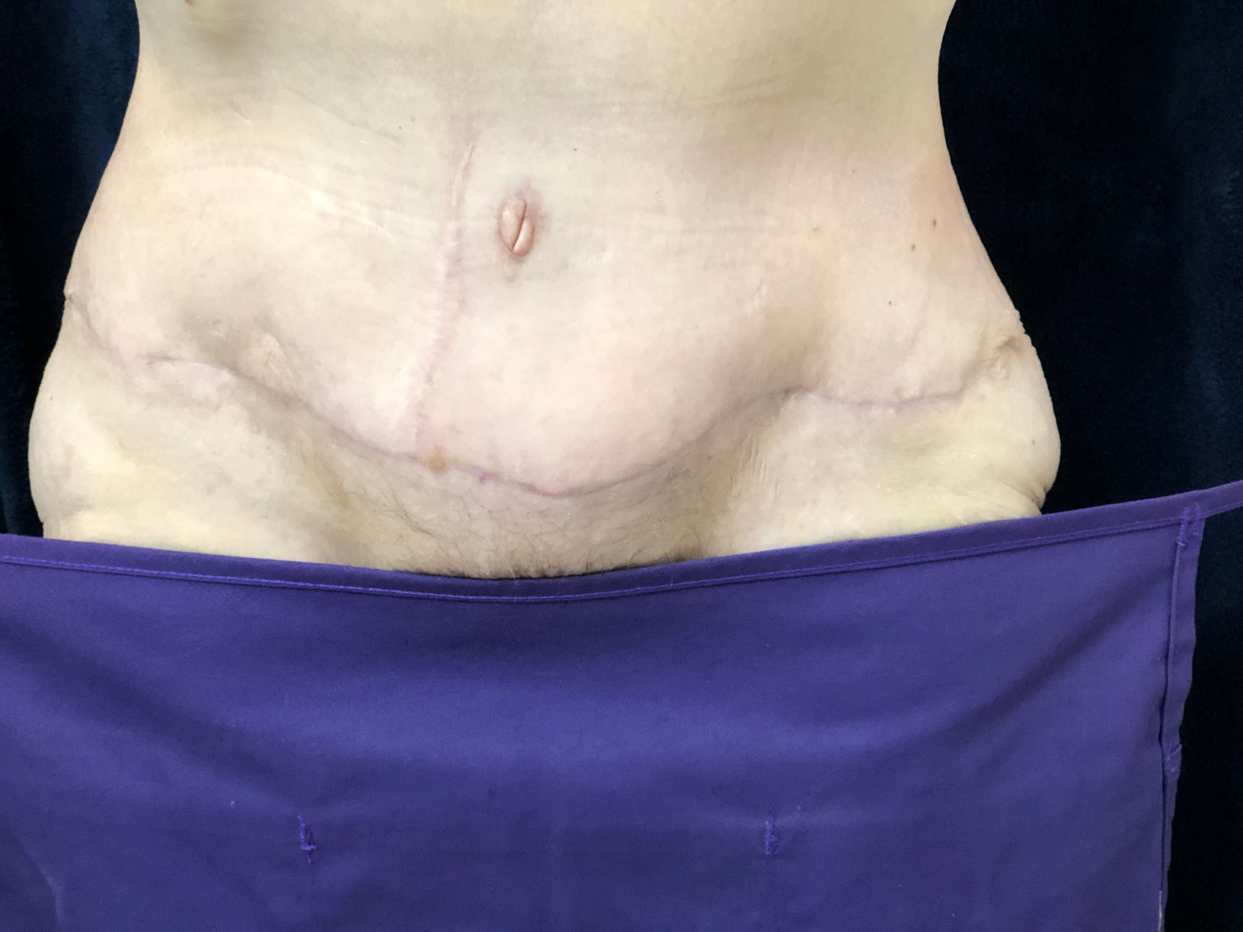 Westlake Woman Has Tummy Tuck After