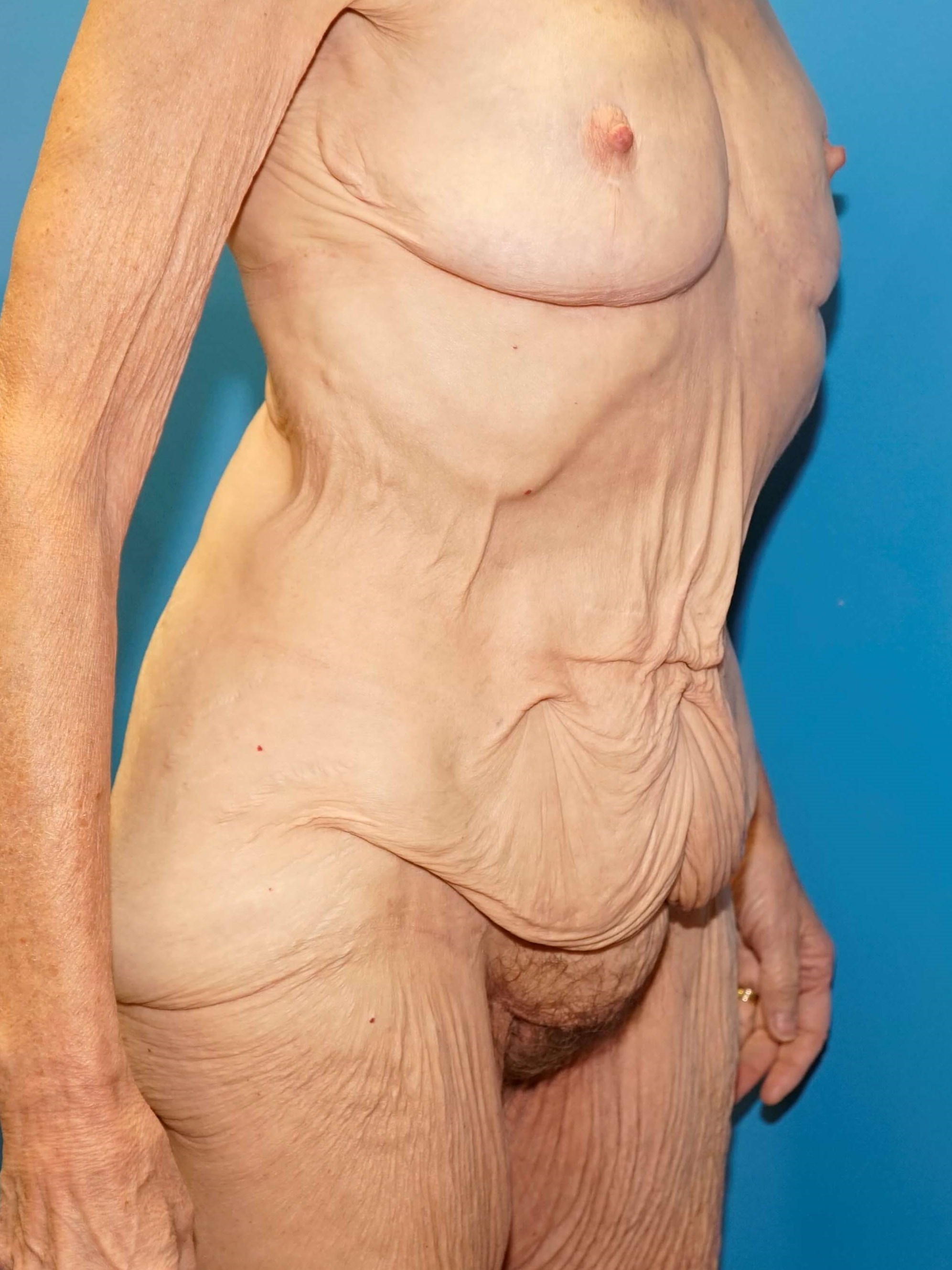 Westlake Woman Has Tummy Tuck Before