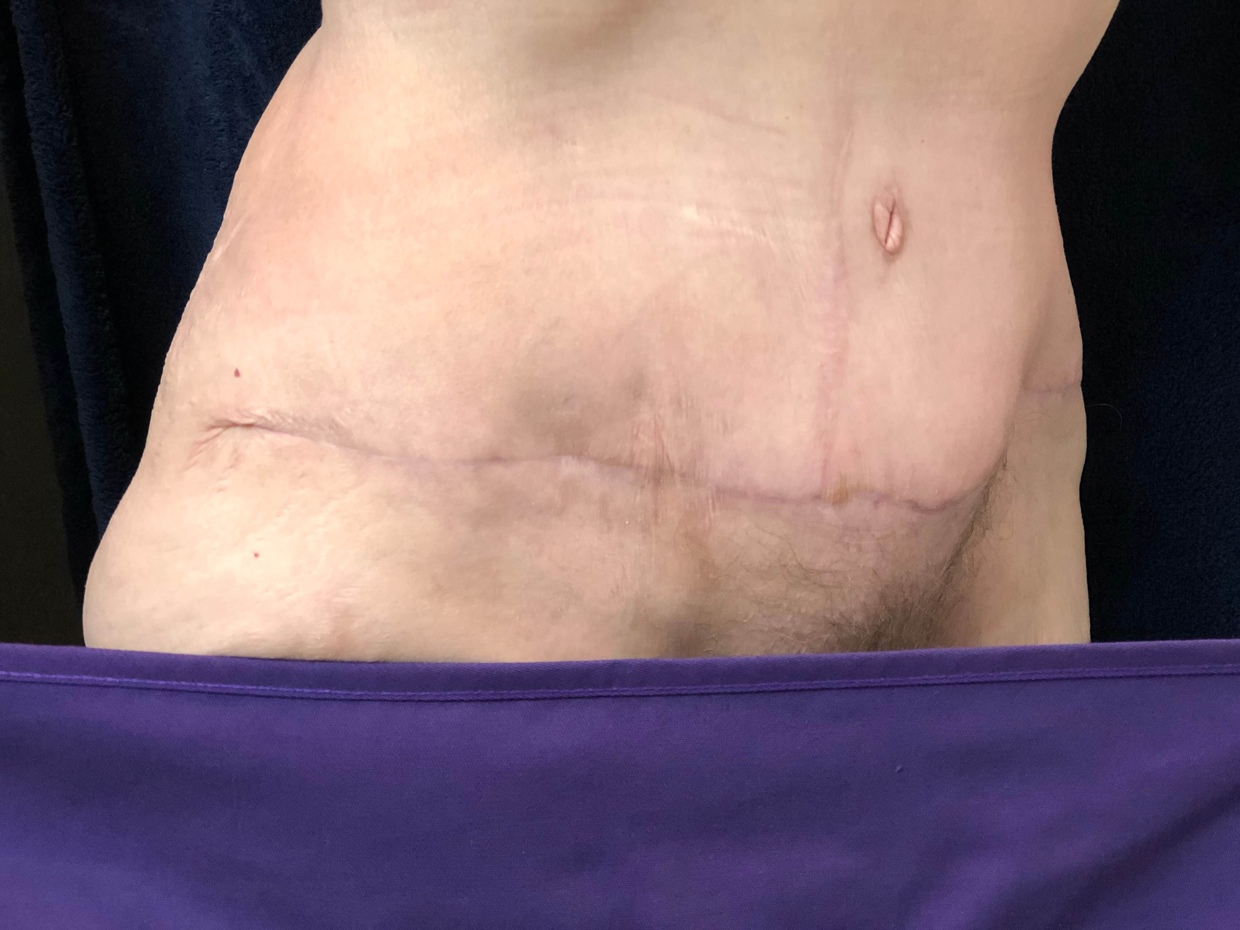 Westlake Woman Has Tummy Tuck After