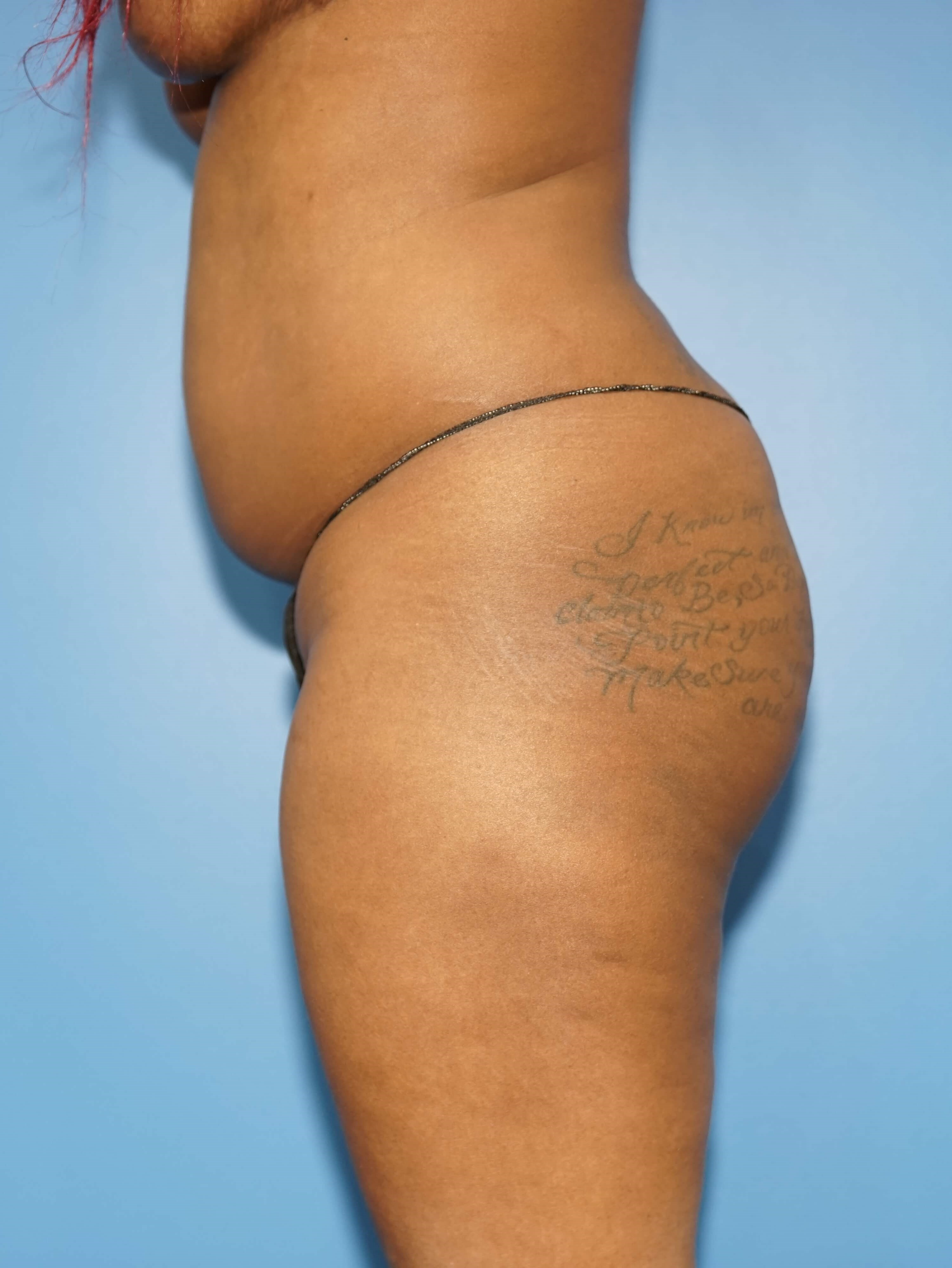 Woman has Fat Transfer to Butt Before