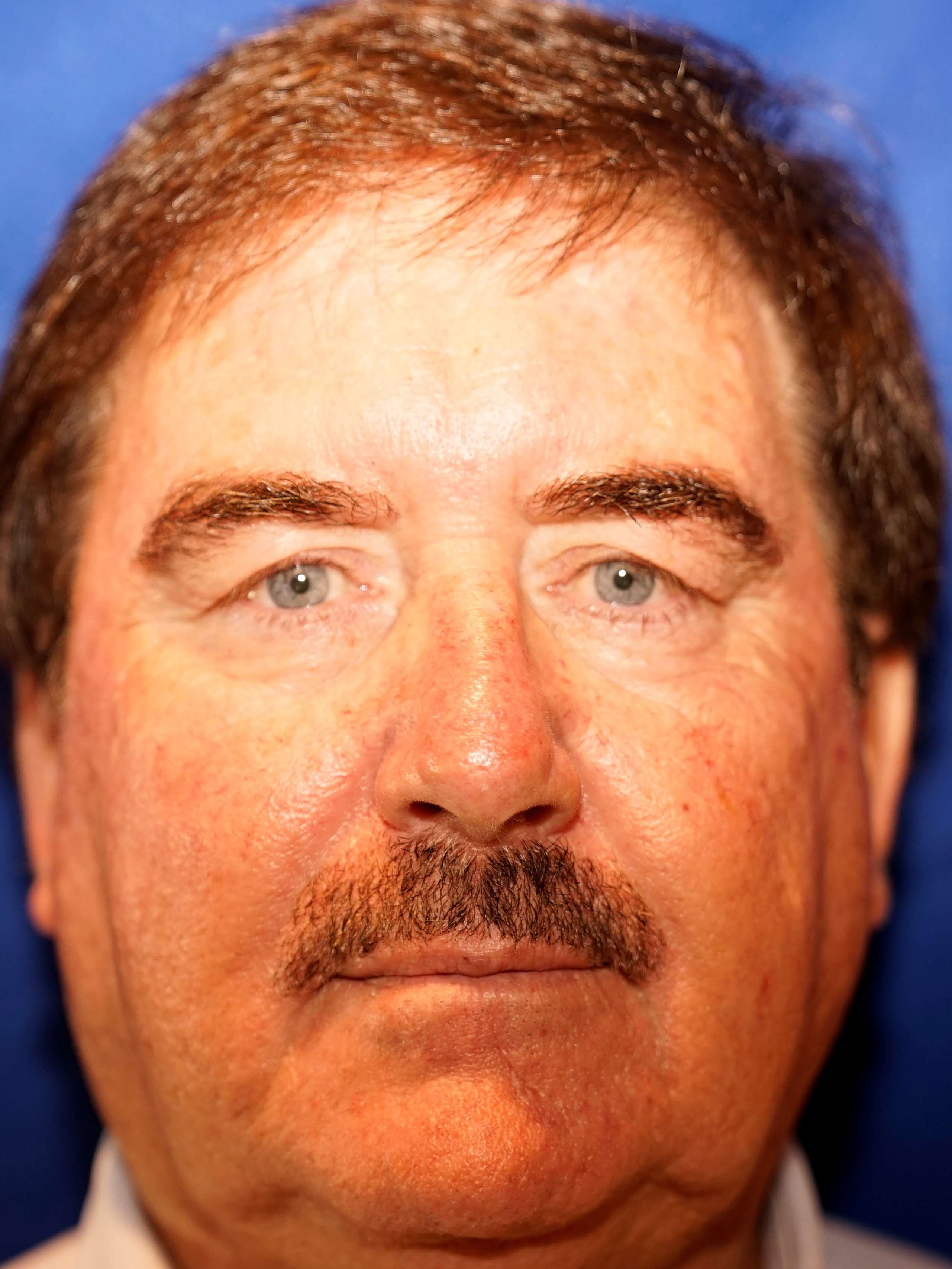Westlake Man has Eyelid Lift Before