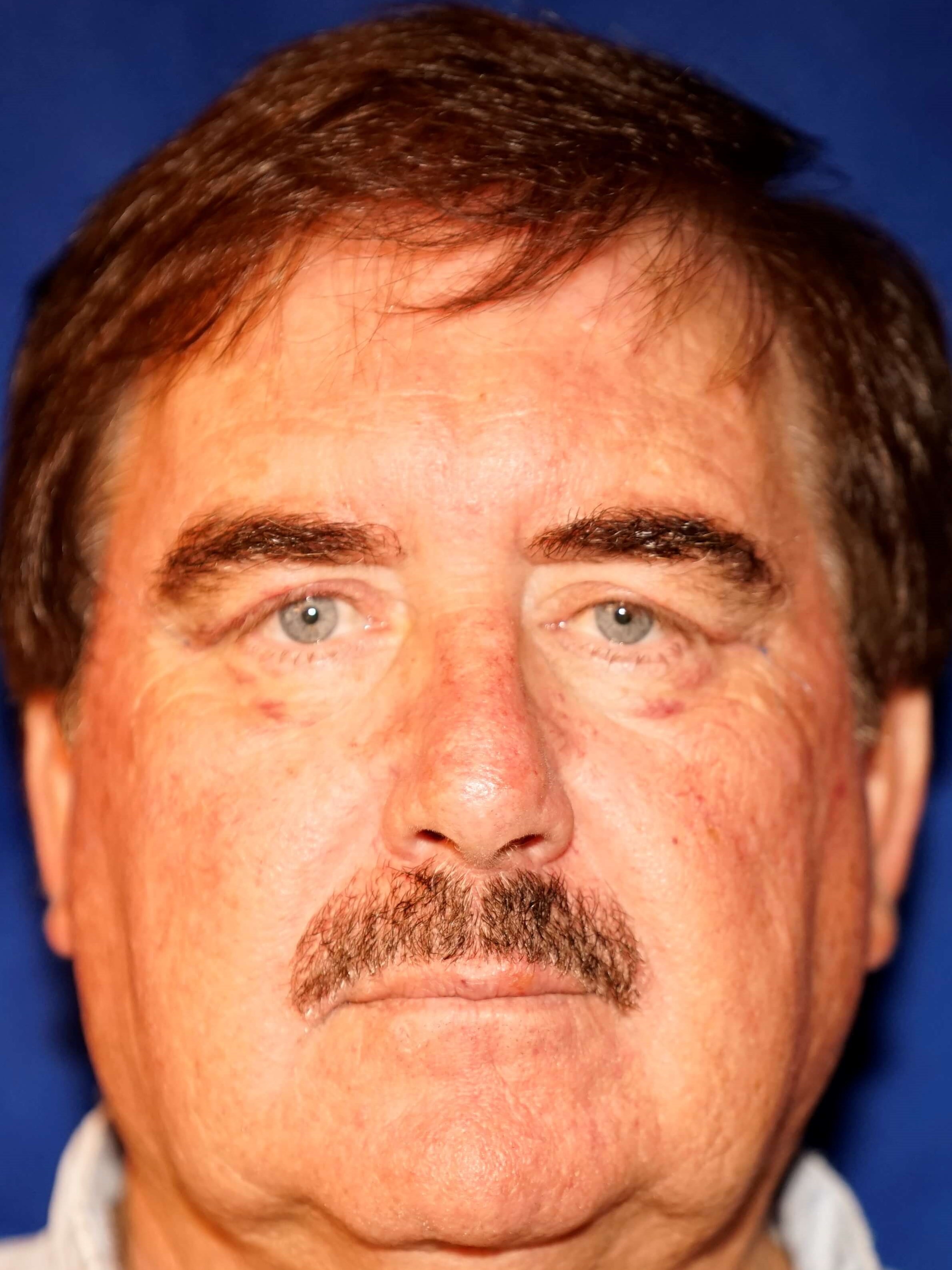 Westlake Man has Eyelid Lift After