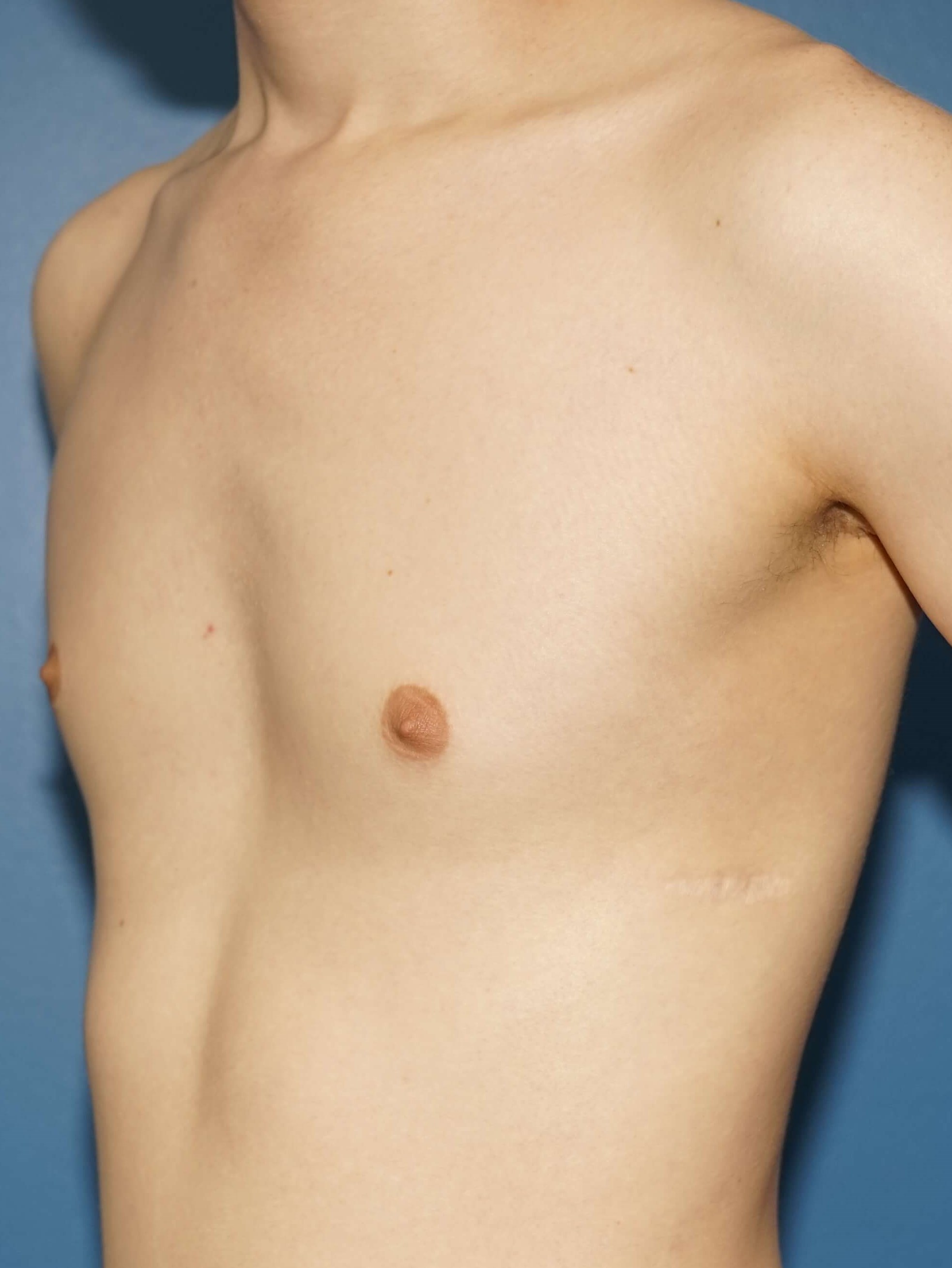 Westlake Man has Gynecomastia Before