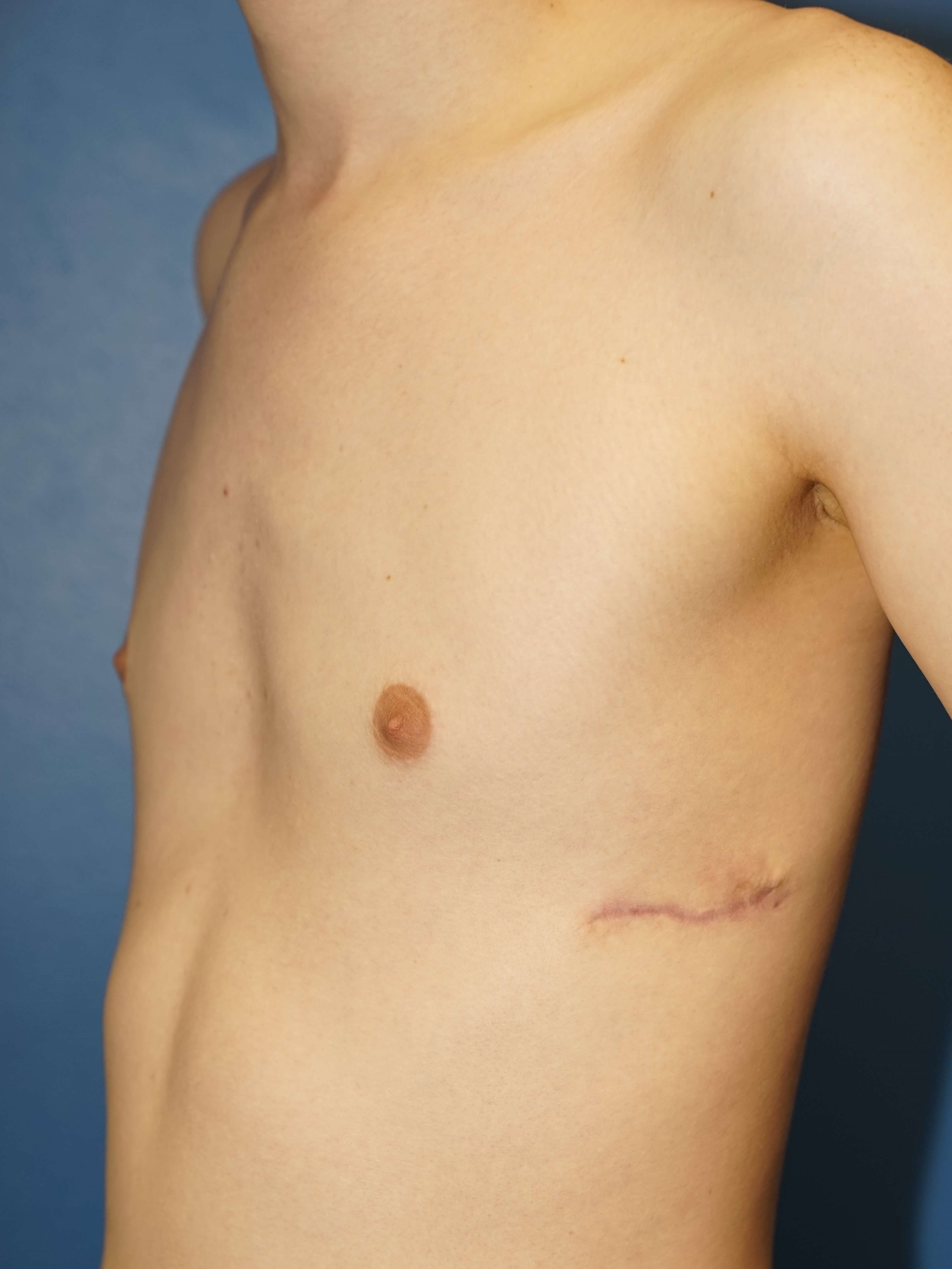 Westlake Man has Gynecomastia After