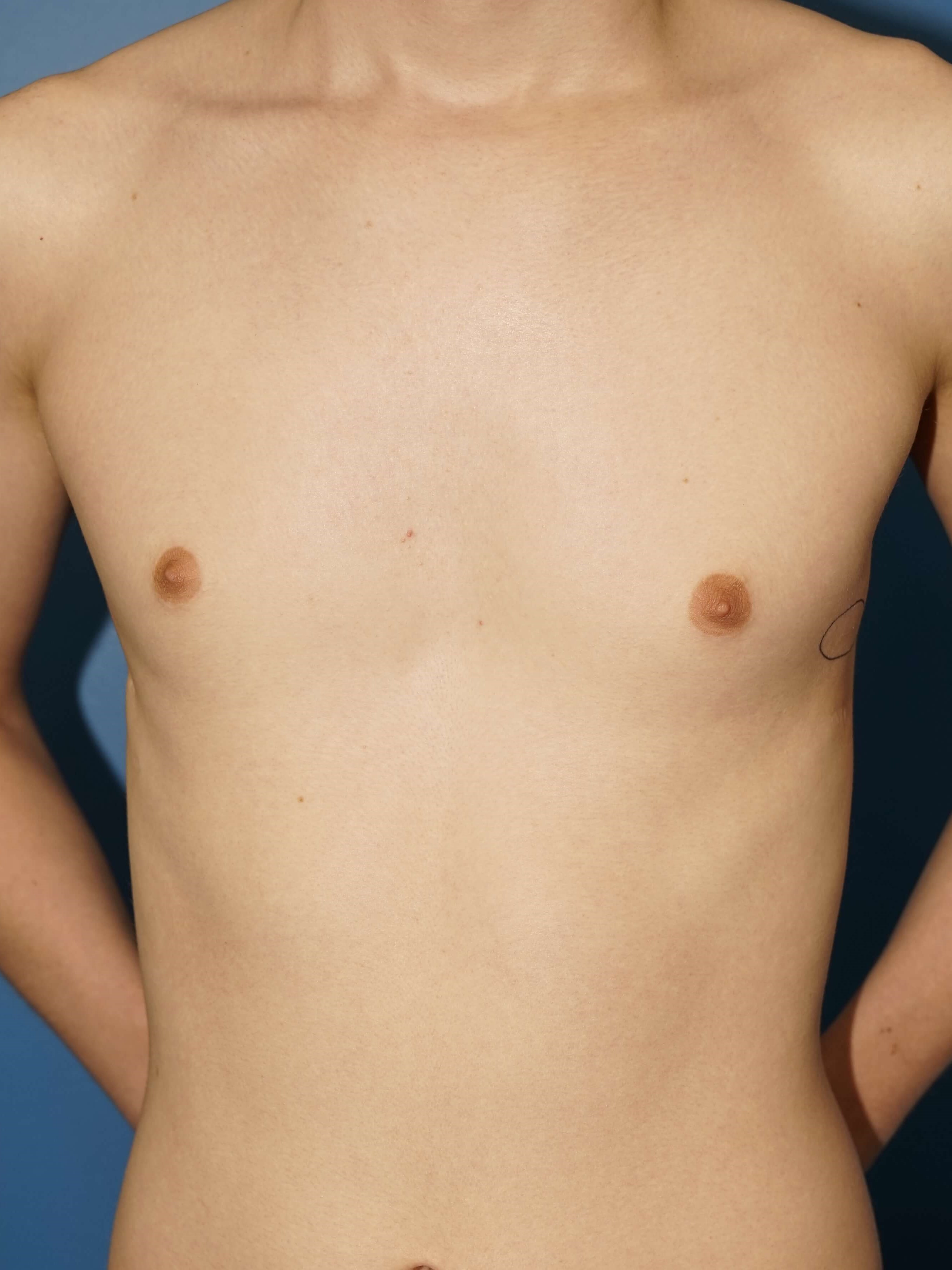 Westlake Man Has Gynecomastia Before