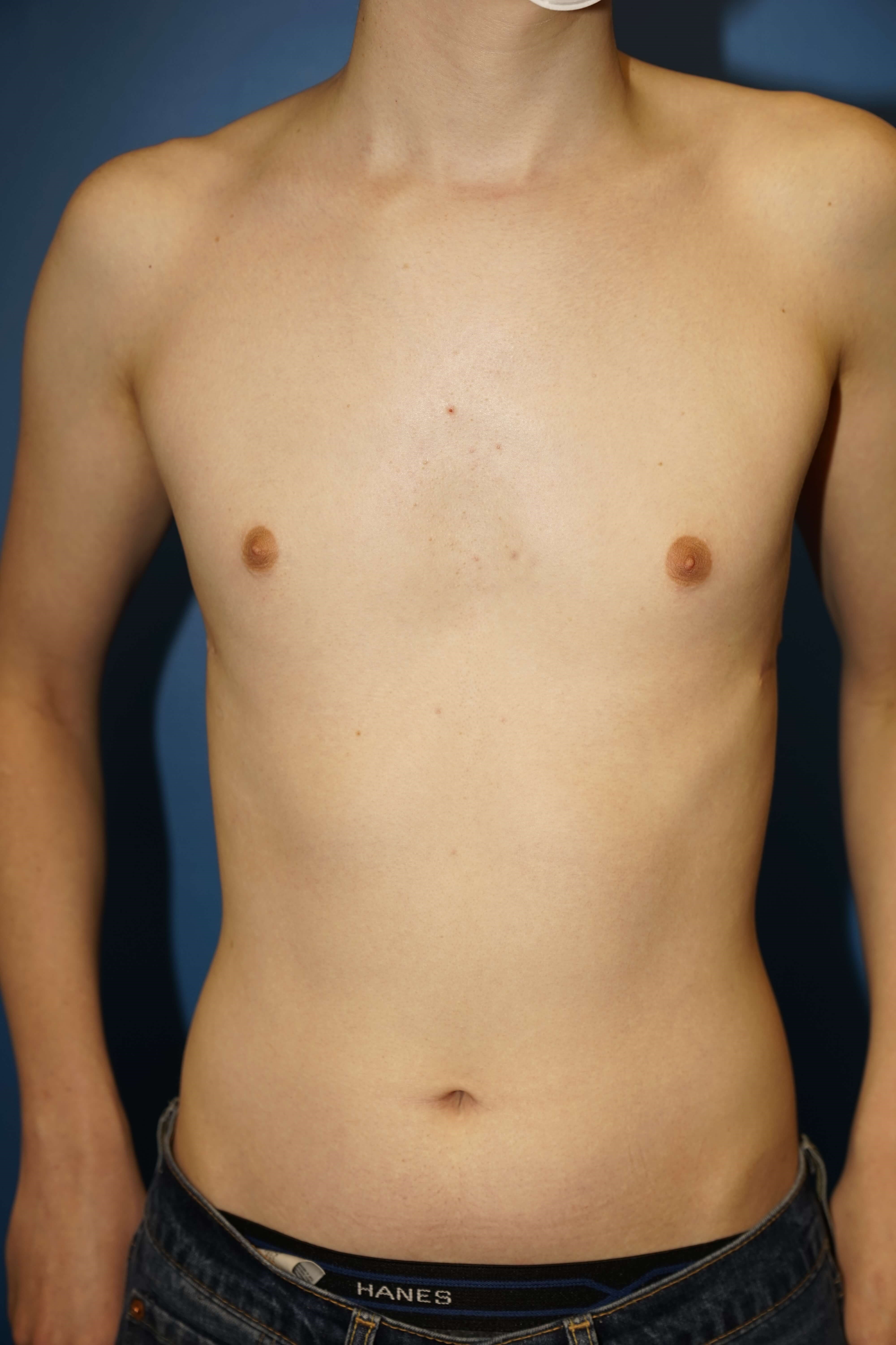 Westlake Man Has Gynecomastia After