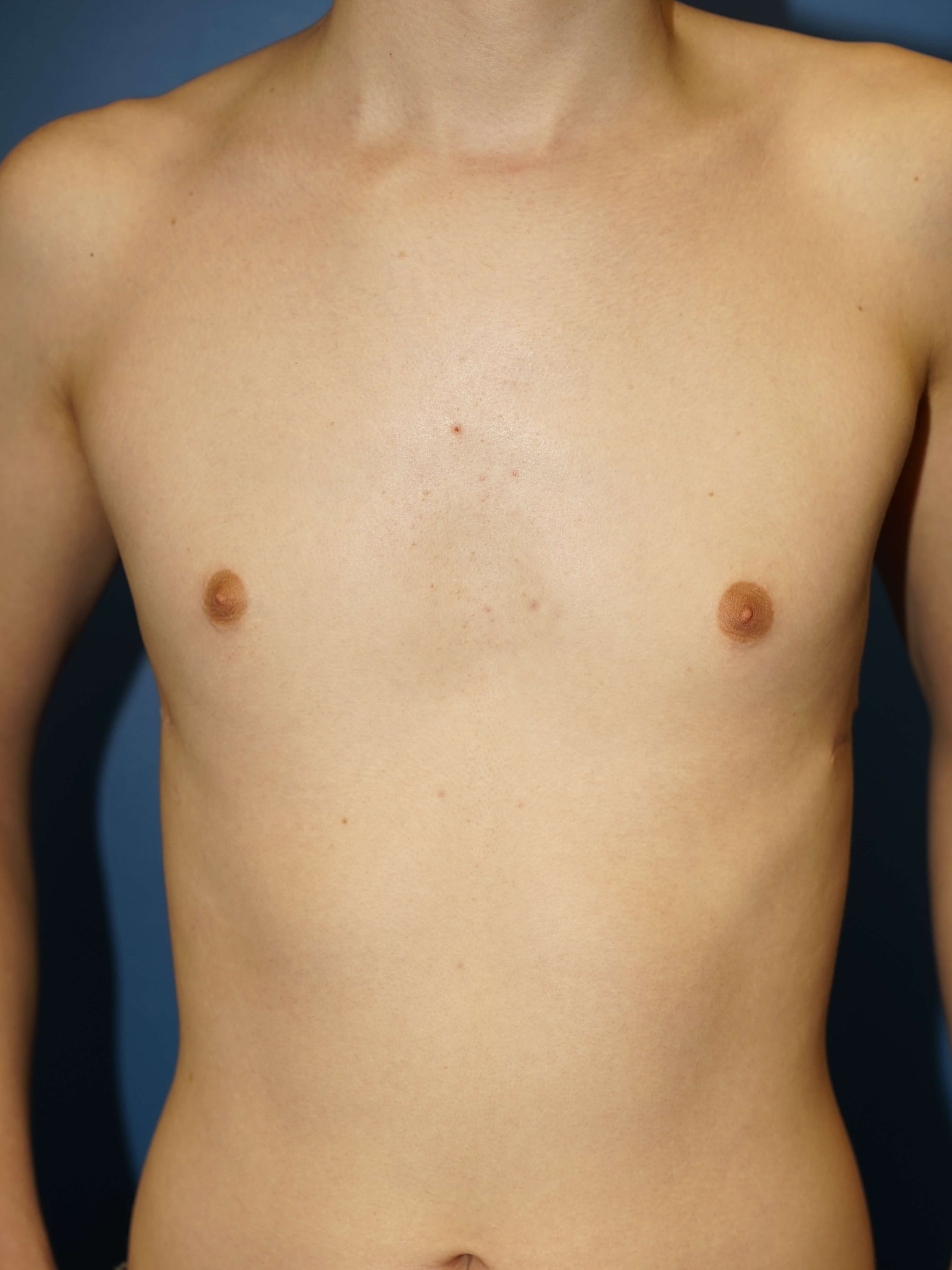 Westlake Man Has Gynecomastia After