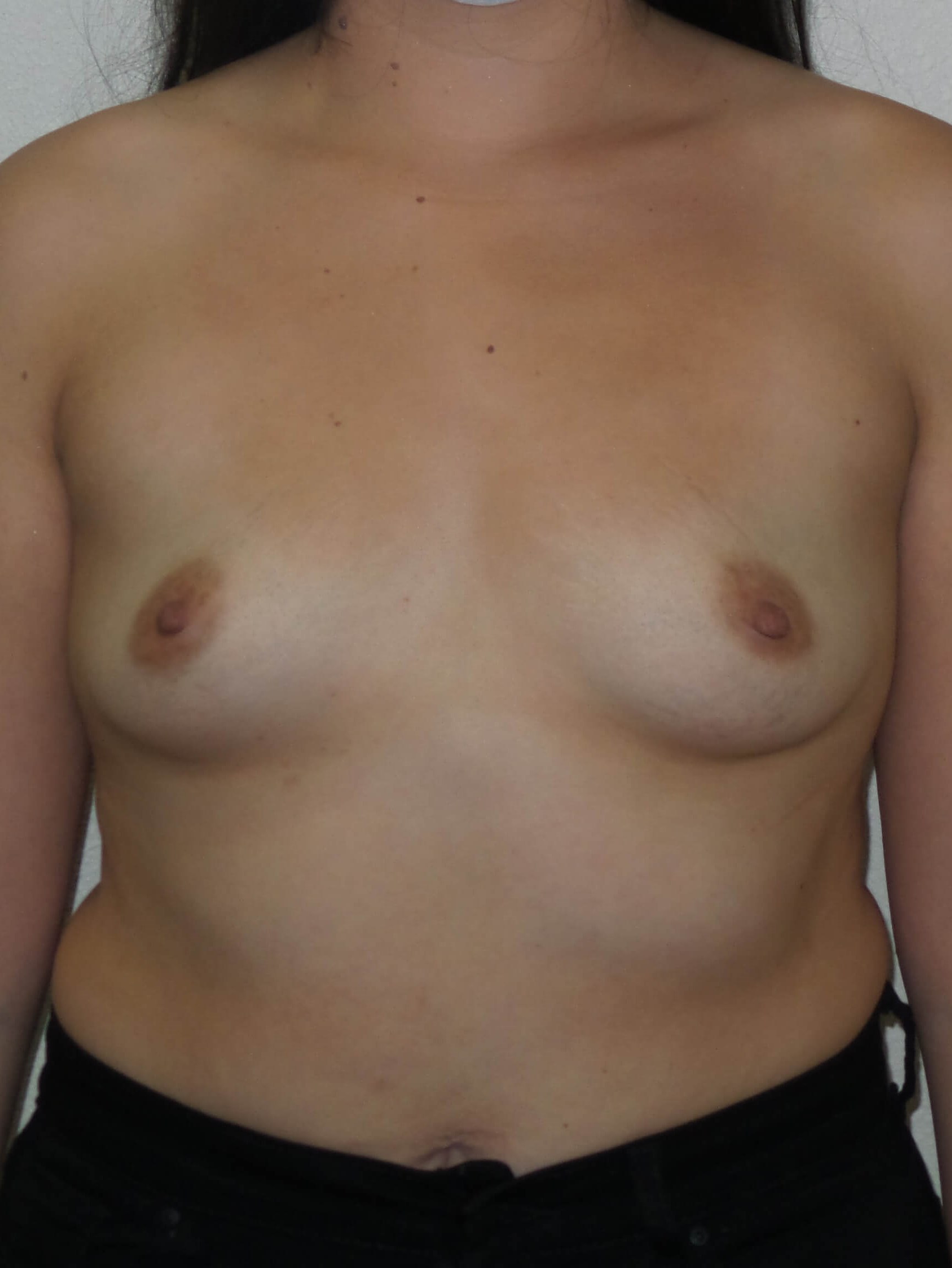 Westlake Woman Has Breast Aug Before