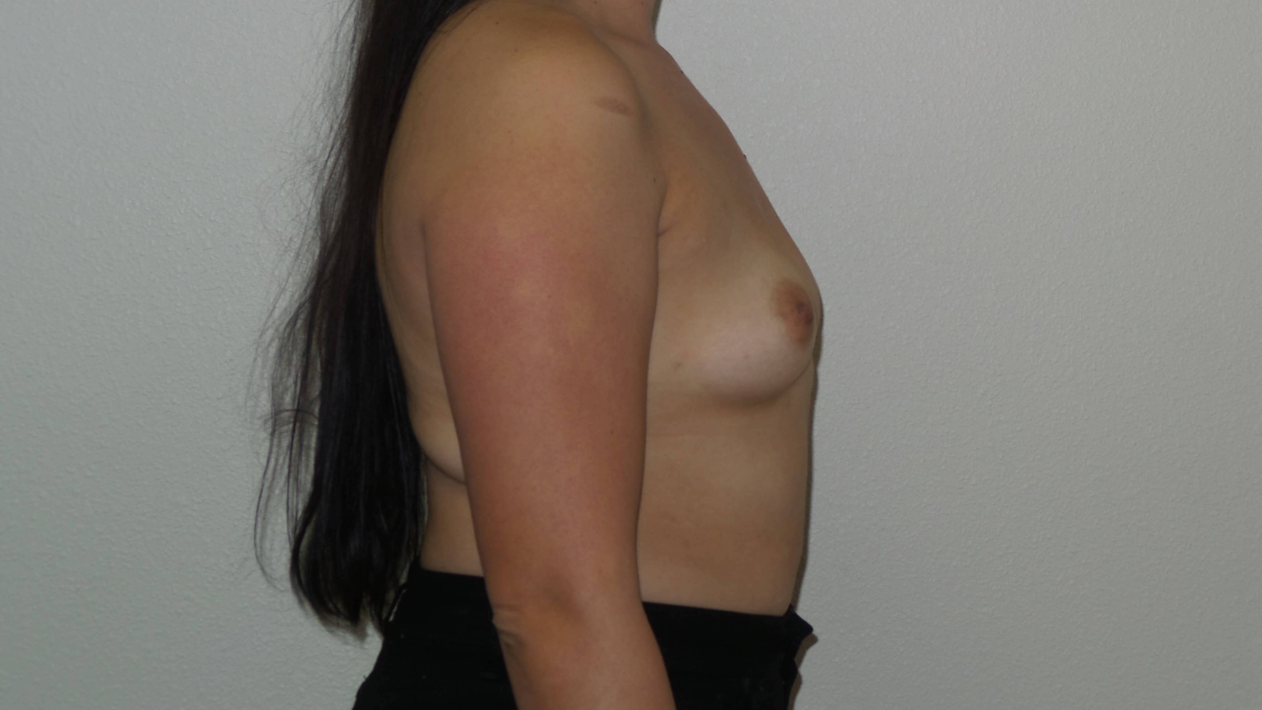 Westlake Woman Has Breast Aug Before