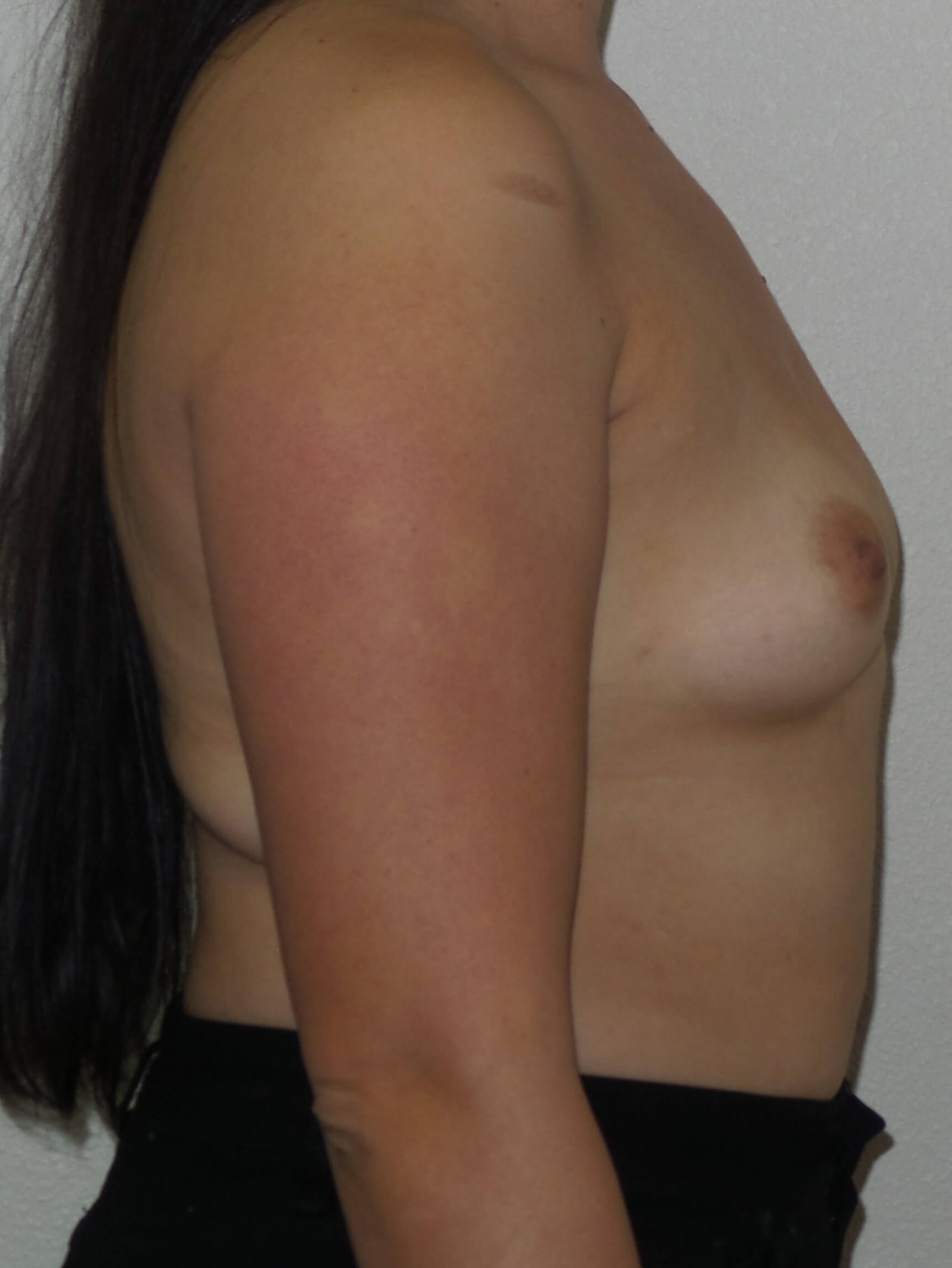 Westlake Woman Has Breast Aug Before