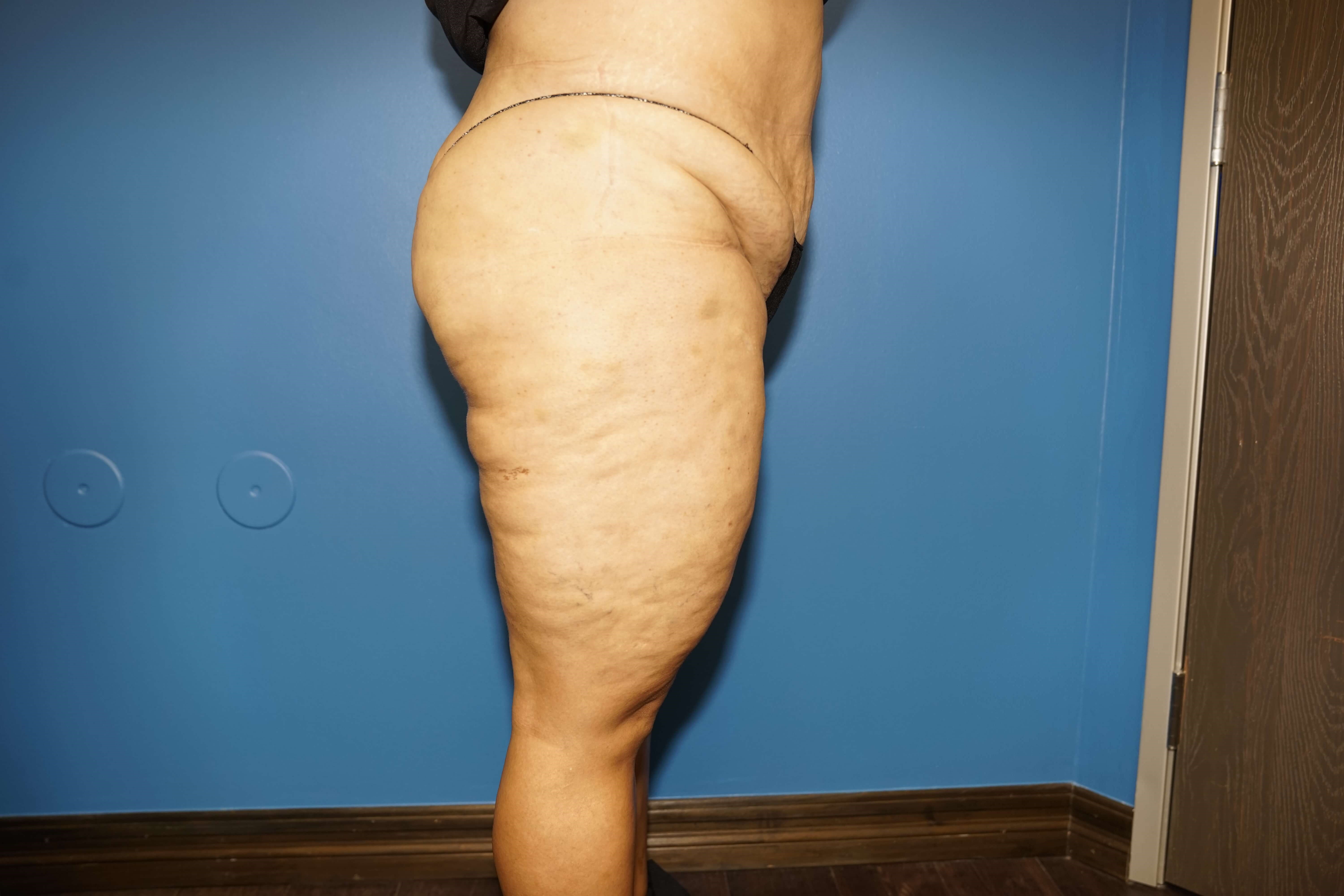 Woman has Mommy Makeover Before
