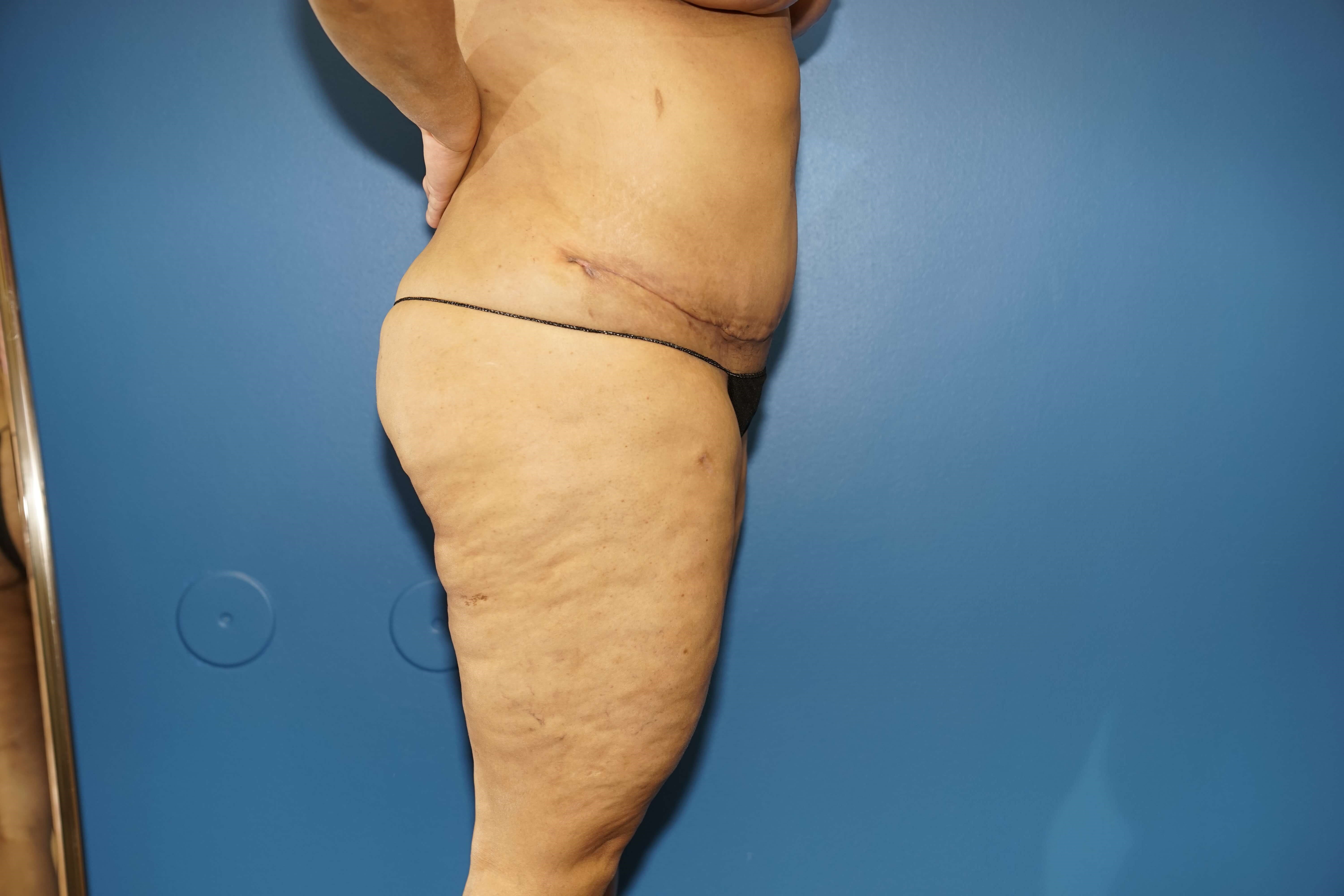 Woman has Mommy Makeover After