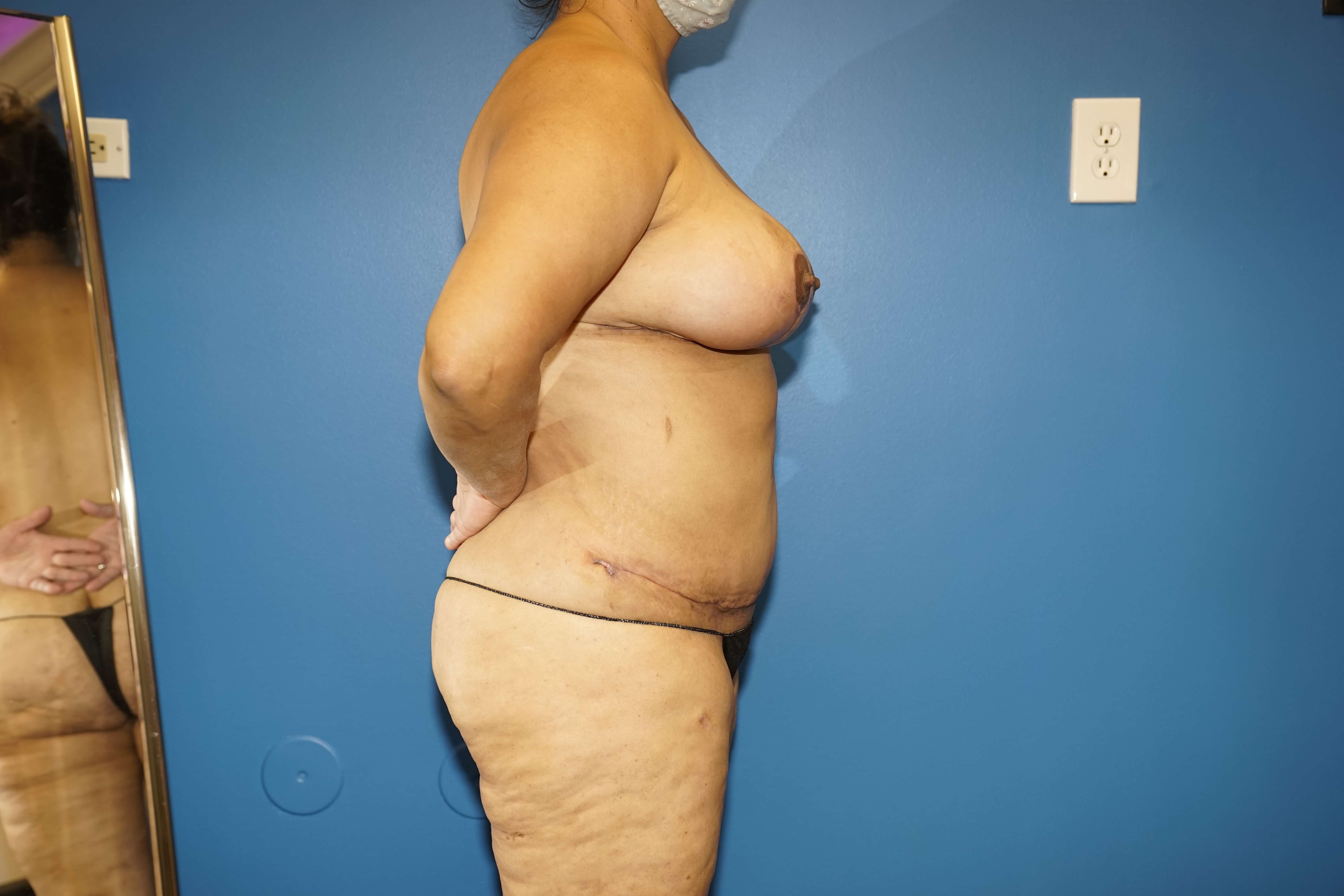 Woman has Mommy Makeover After