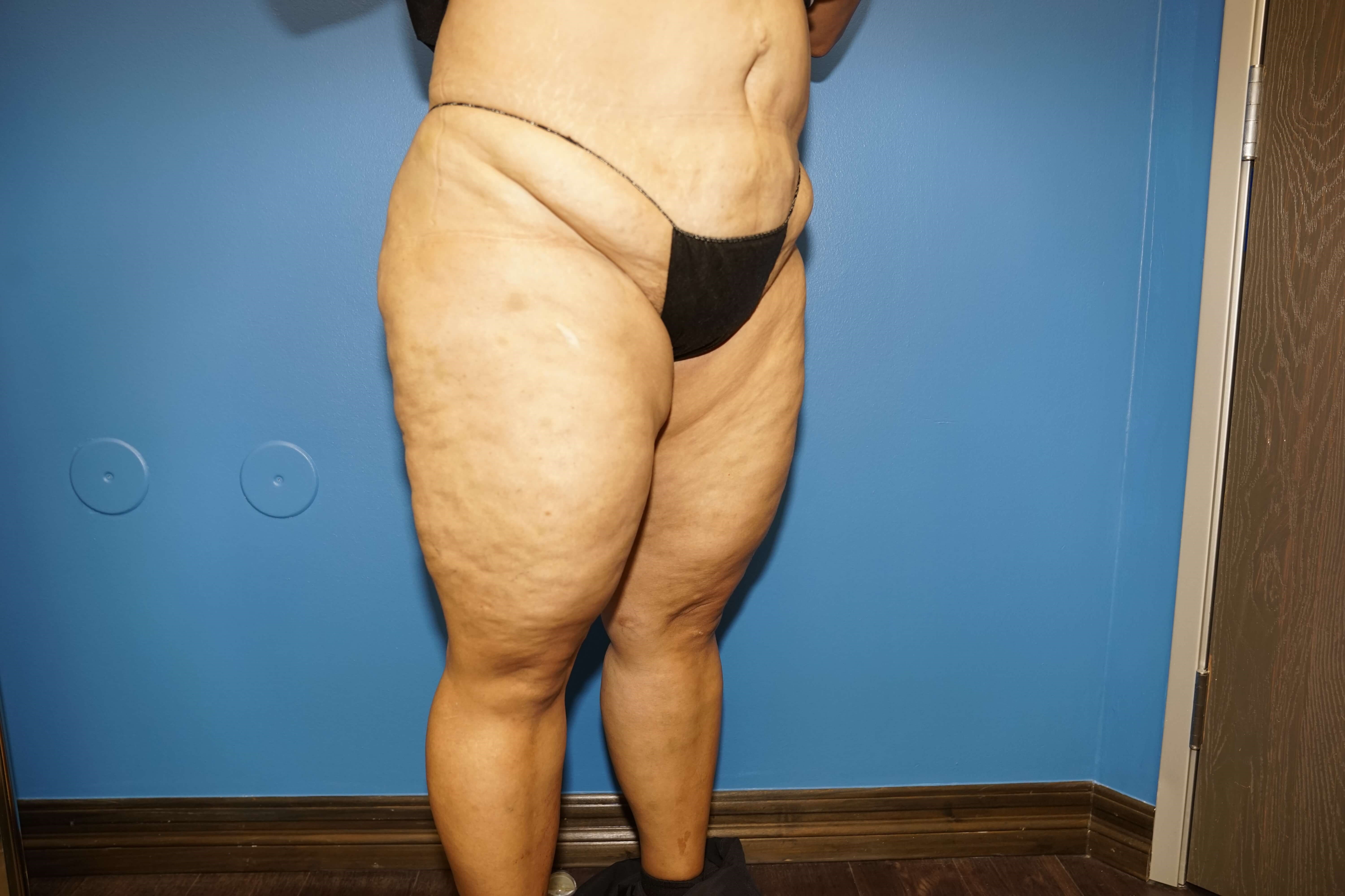 Westlake Woman Has Mastopexy Before