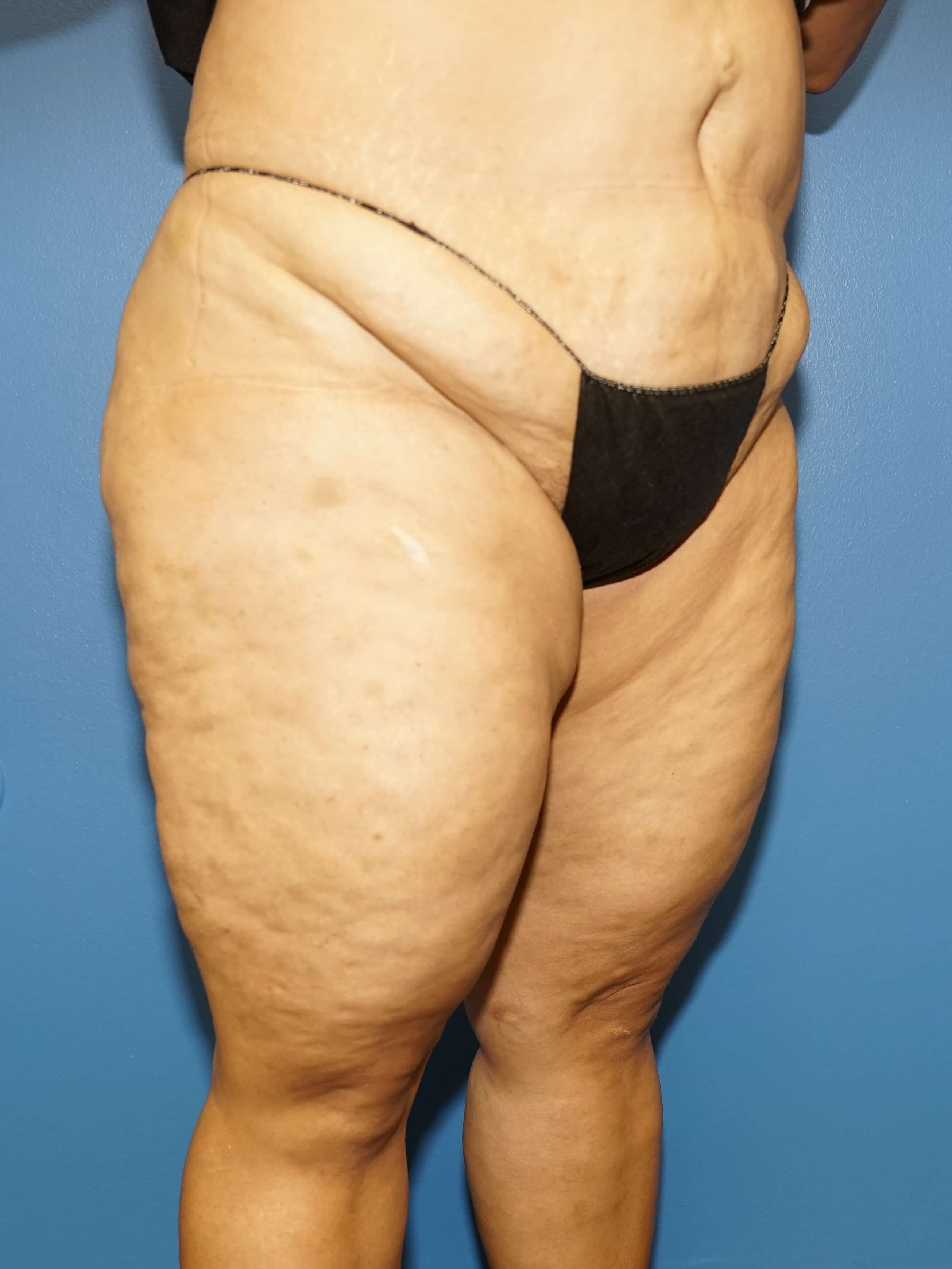 Westlake Woman Has Mastopexy Before