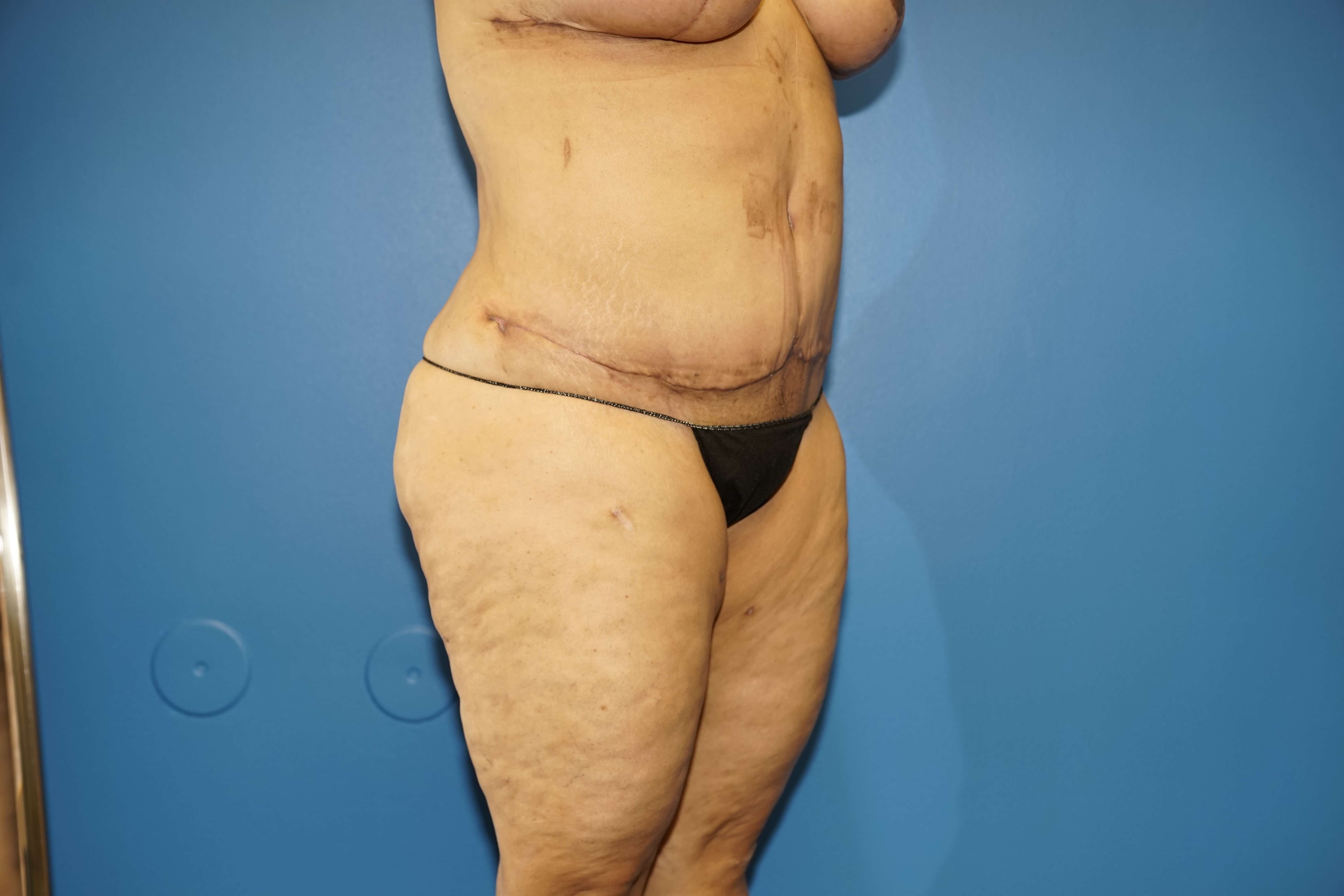 Westlake Woman Has Mastopexy After