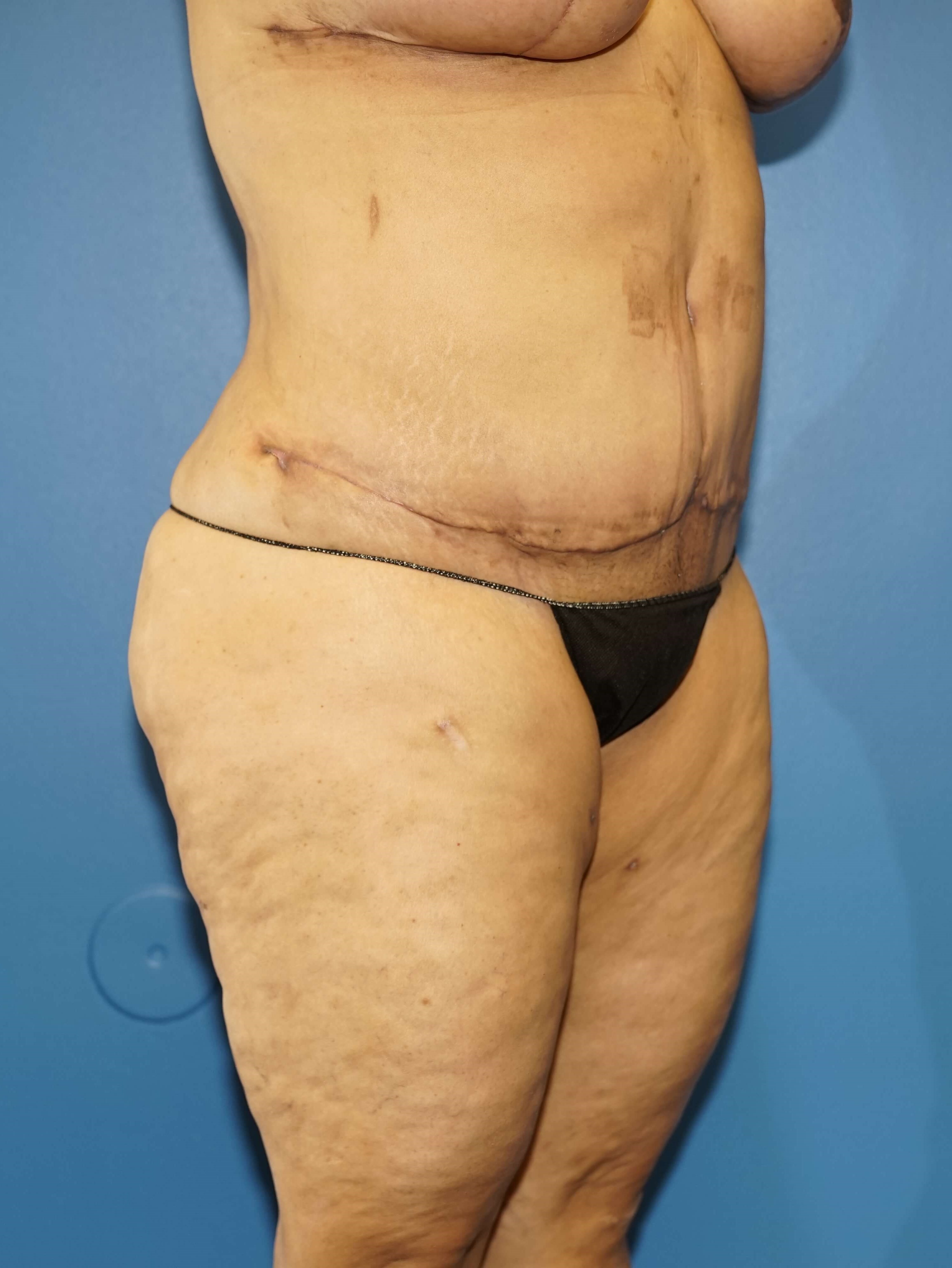 Westlake Woman Has Mastopexy After