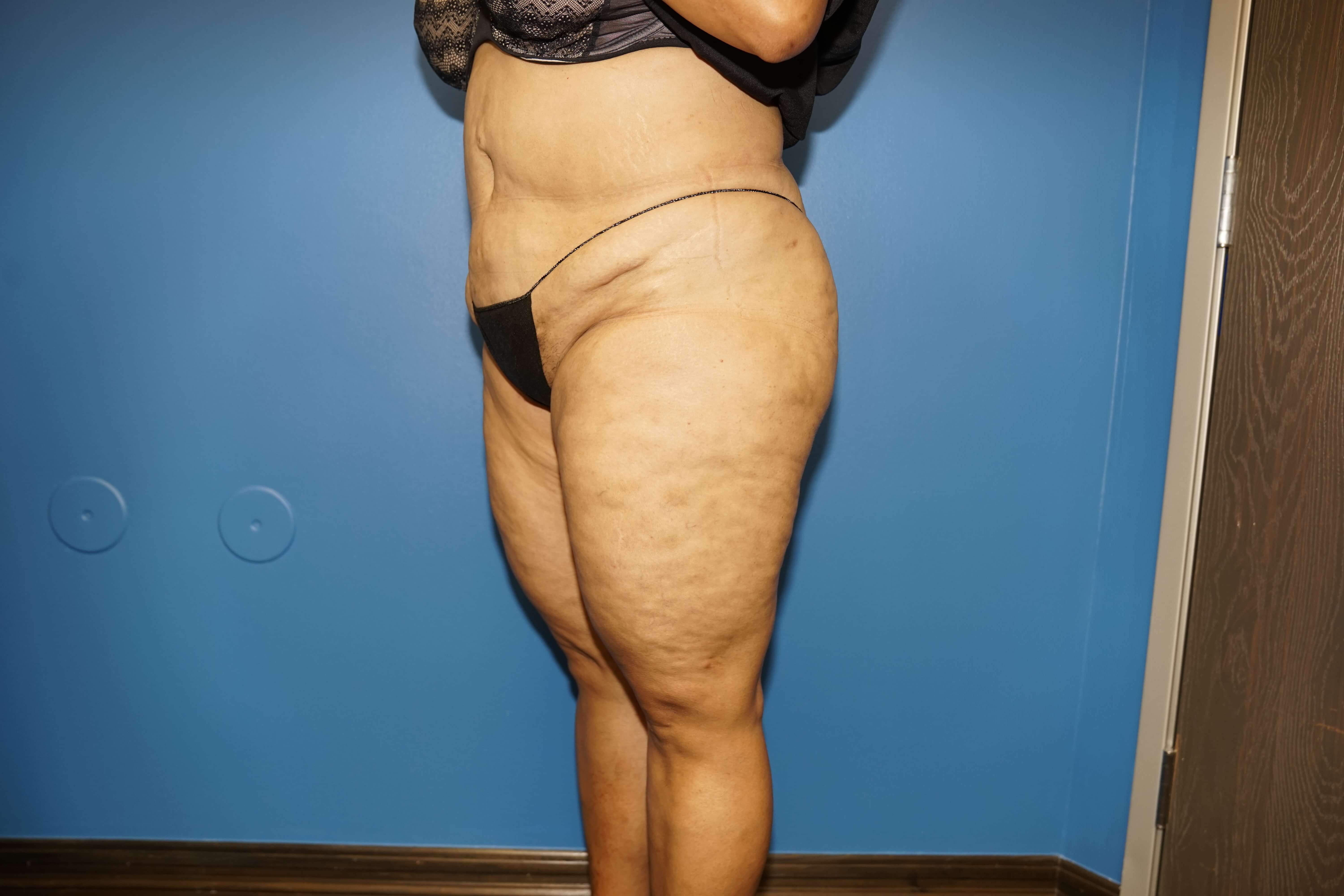 Westlake Woman Has Tummy Tuck Before