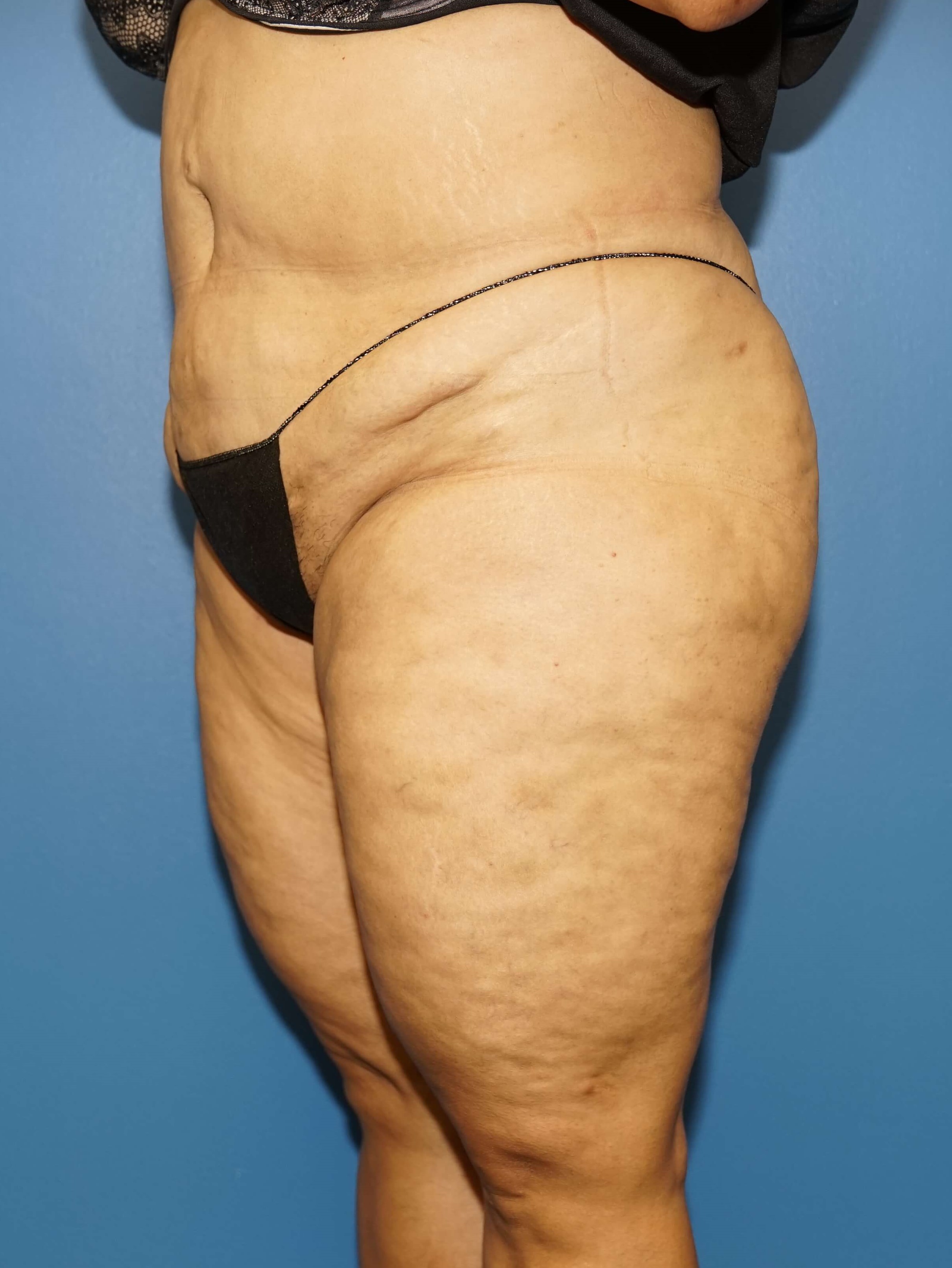 Westlake Woman Has Tummy Tuck Before