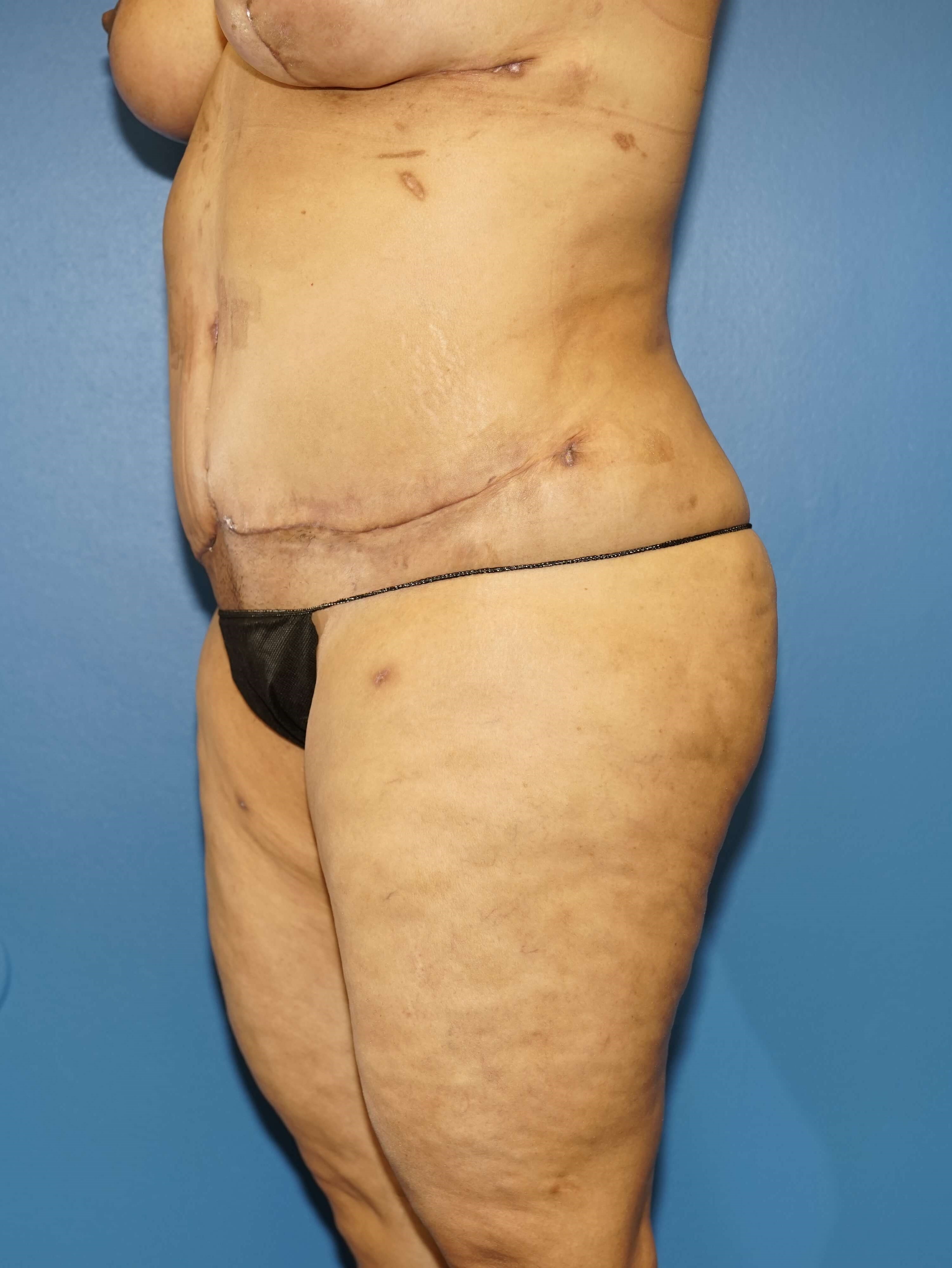 Westlake Woman Has Tummy Tuck After