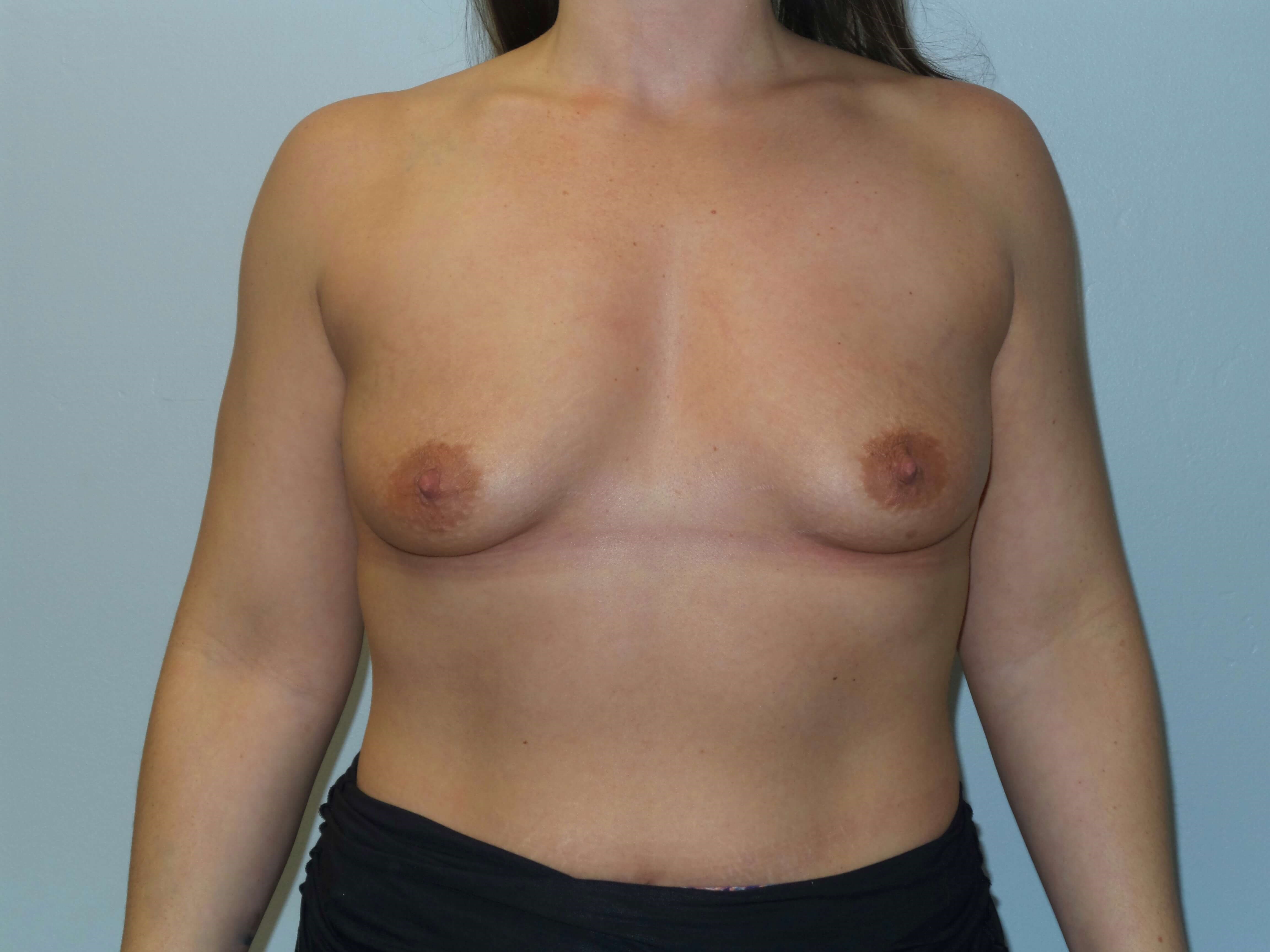 Westlake Woman Has Breast Aug Before