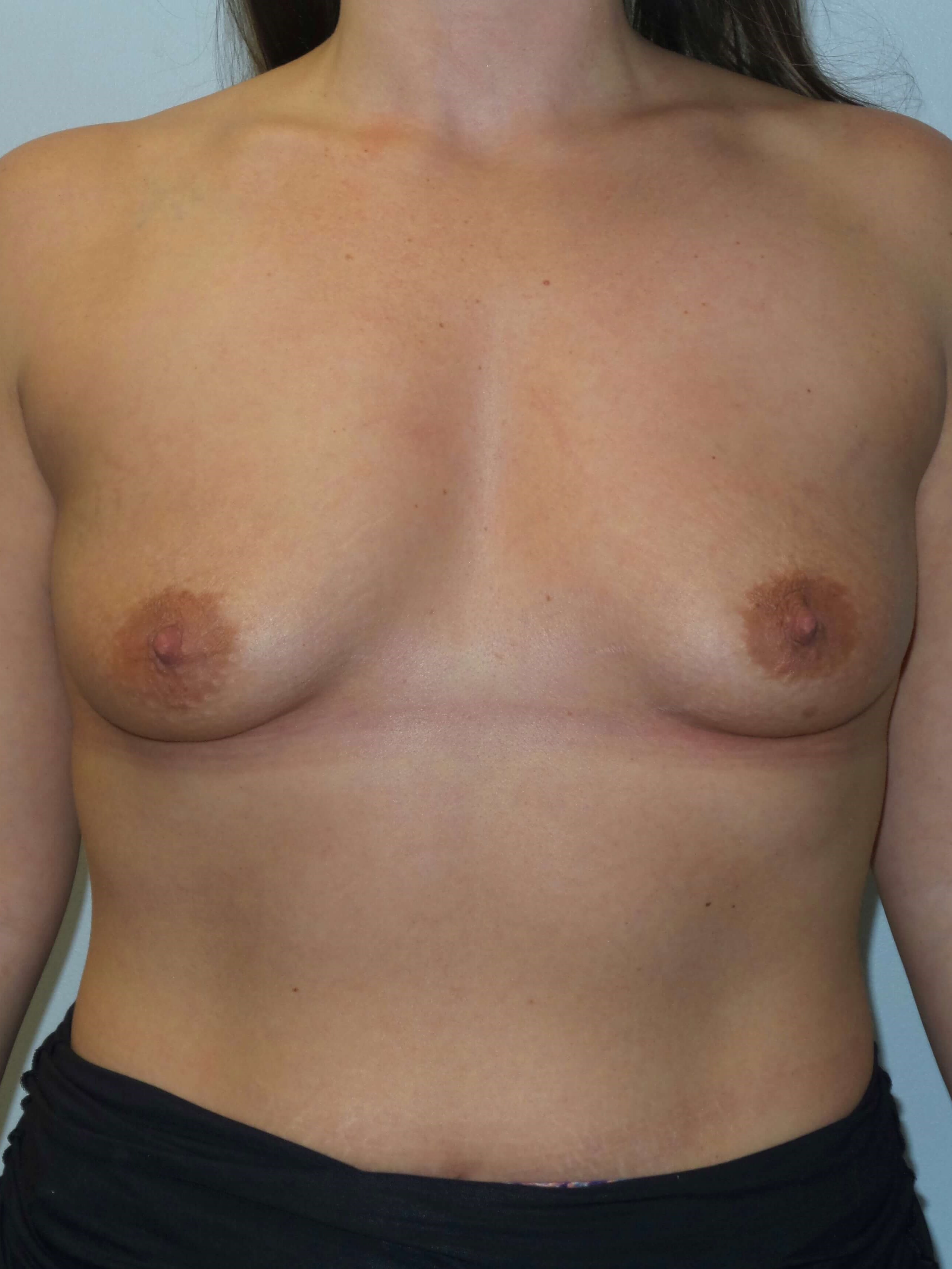 Westlake Woman Has Breast Aug Before