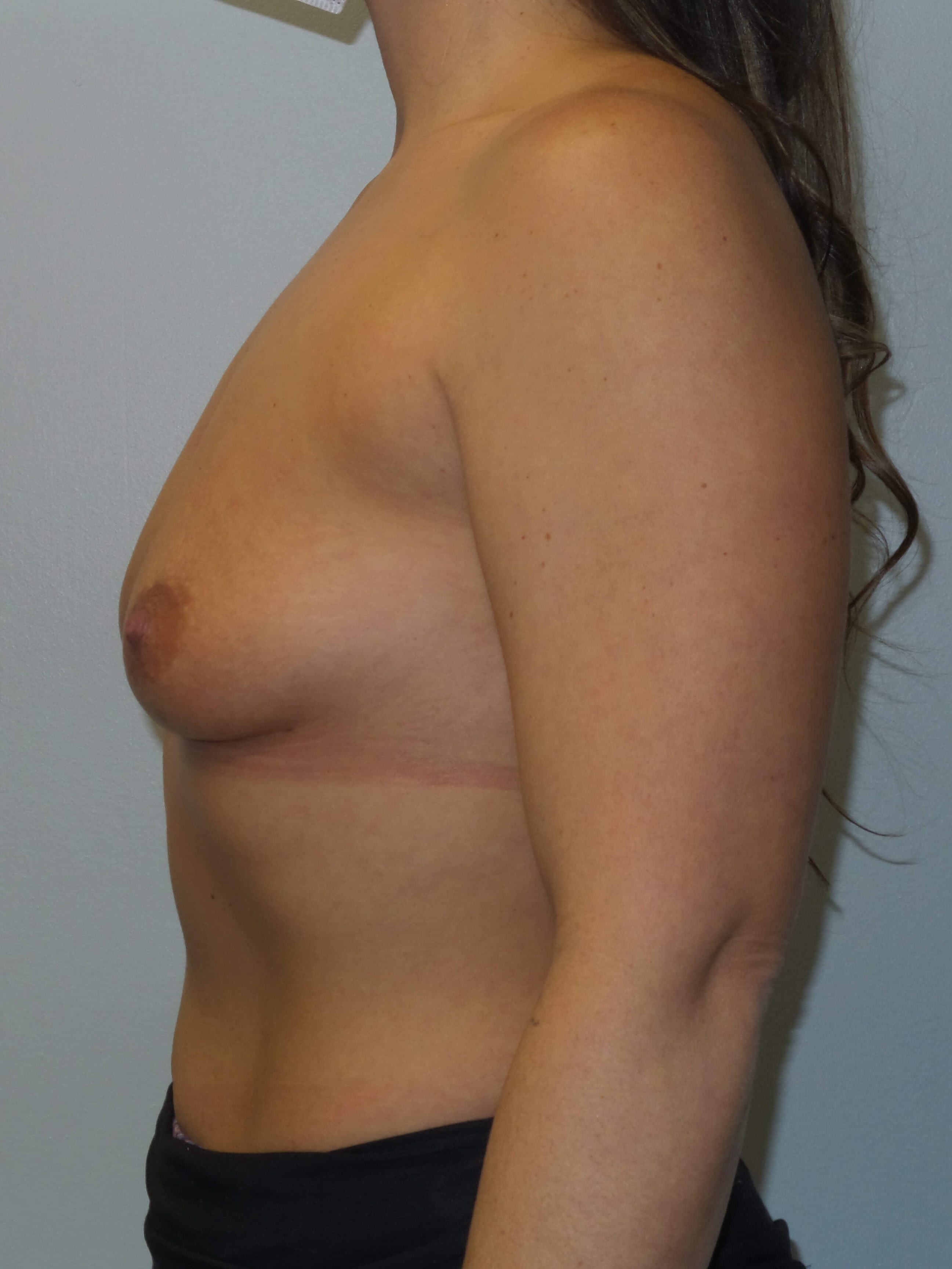 Westlake Woman Has Breast Aug Before