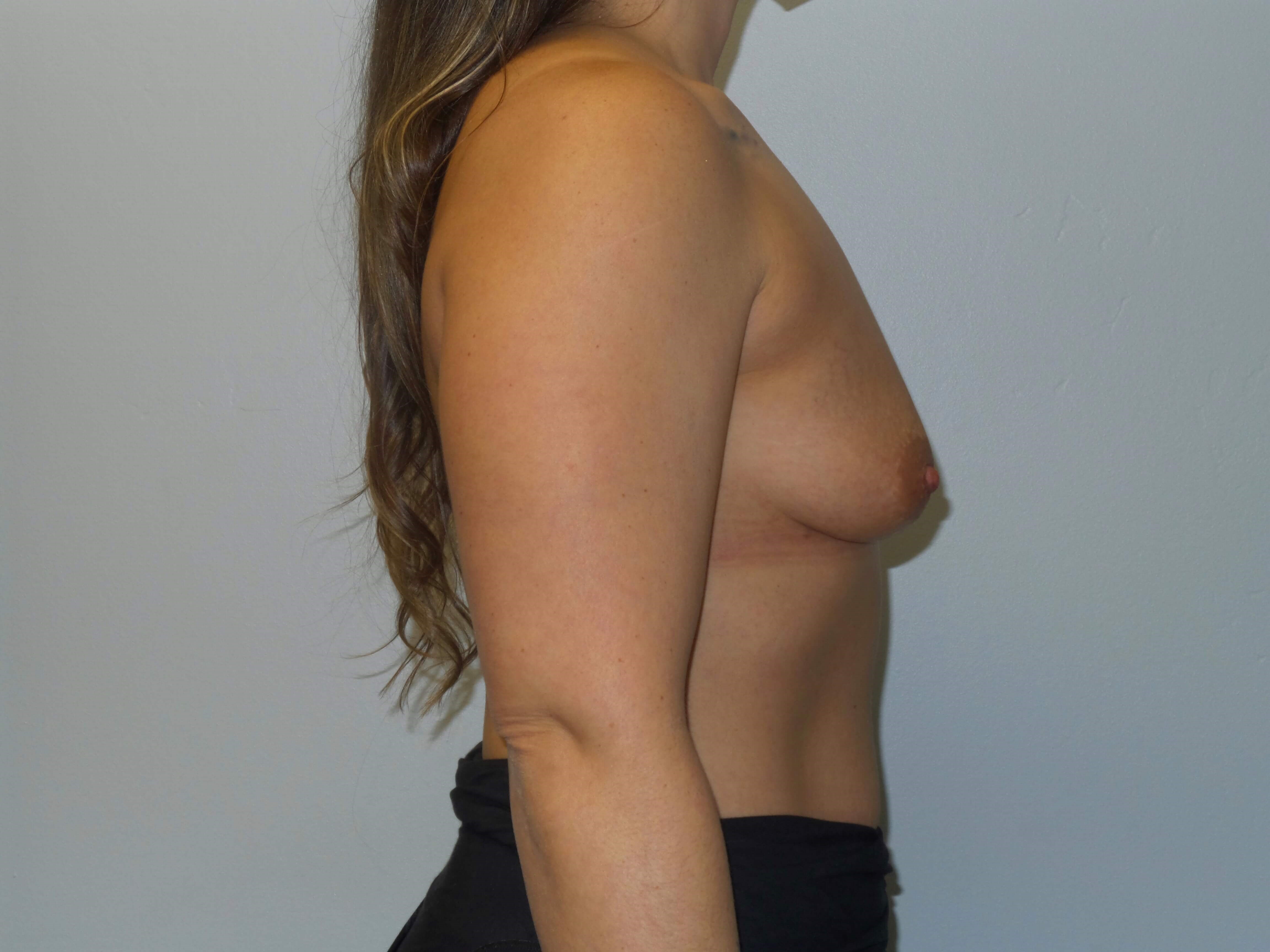 Westlake Woman Has Breast Aug Before
