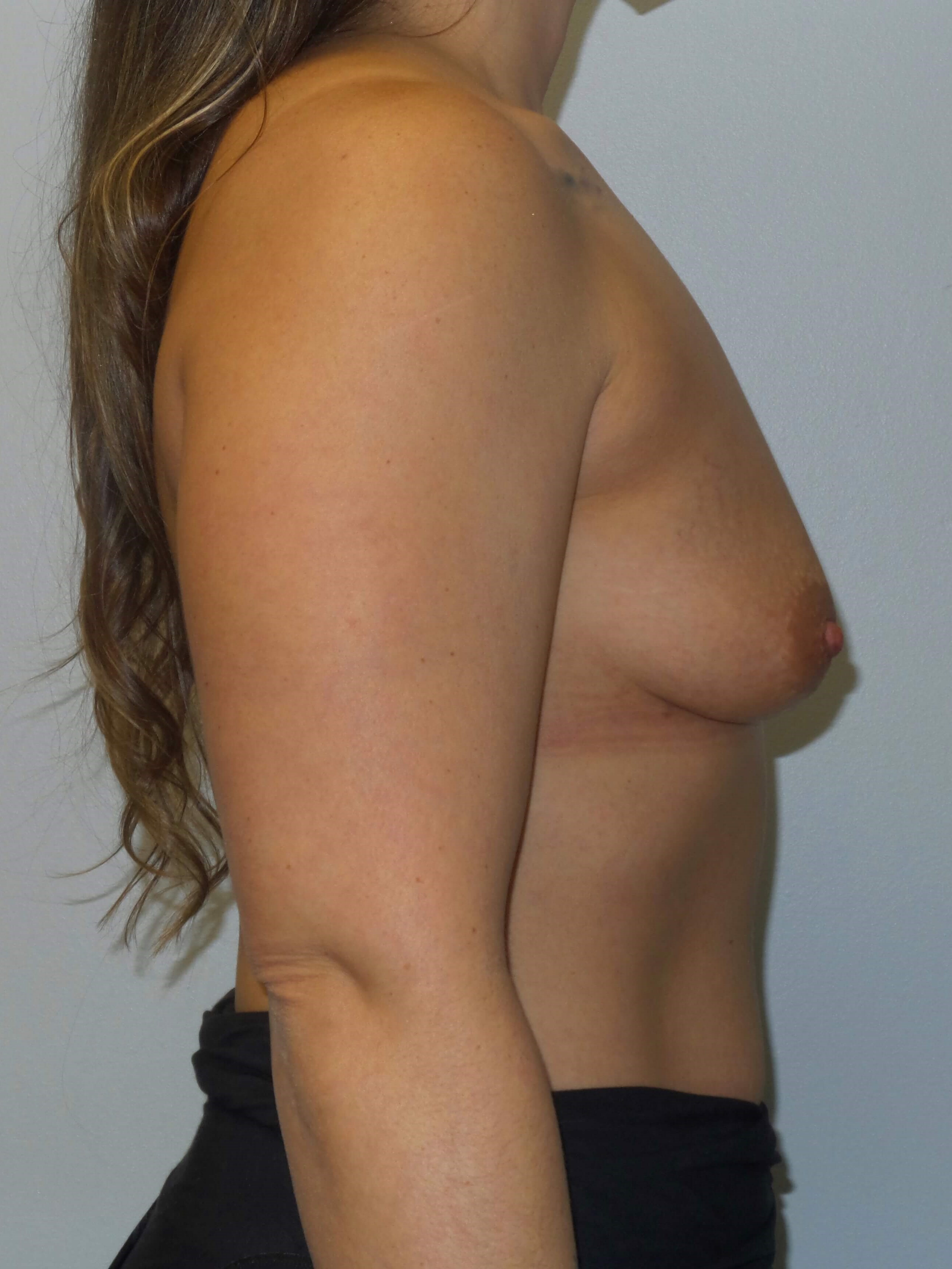 Westlake Woman Has Breast Aug Before