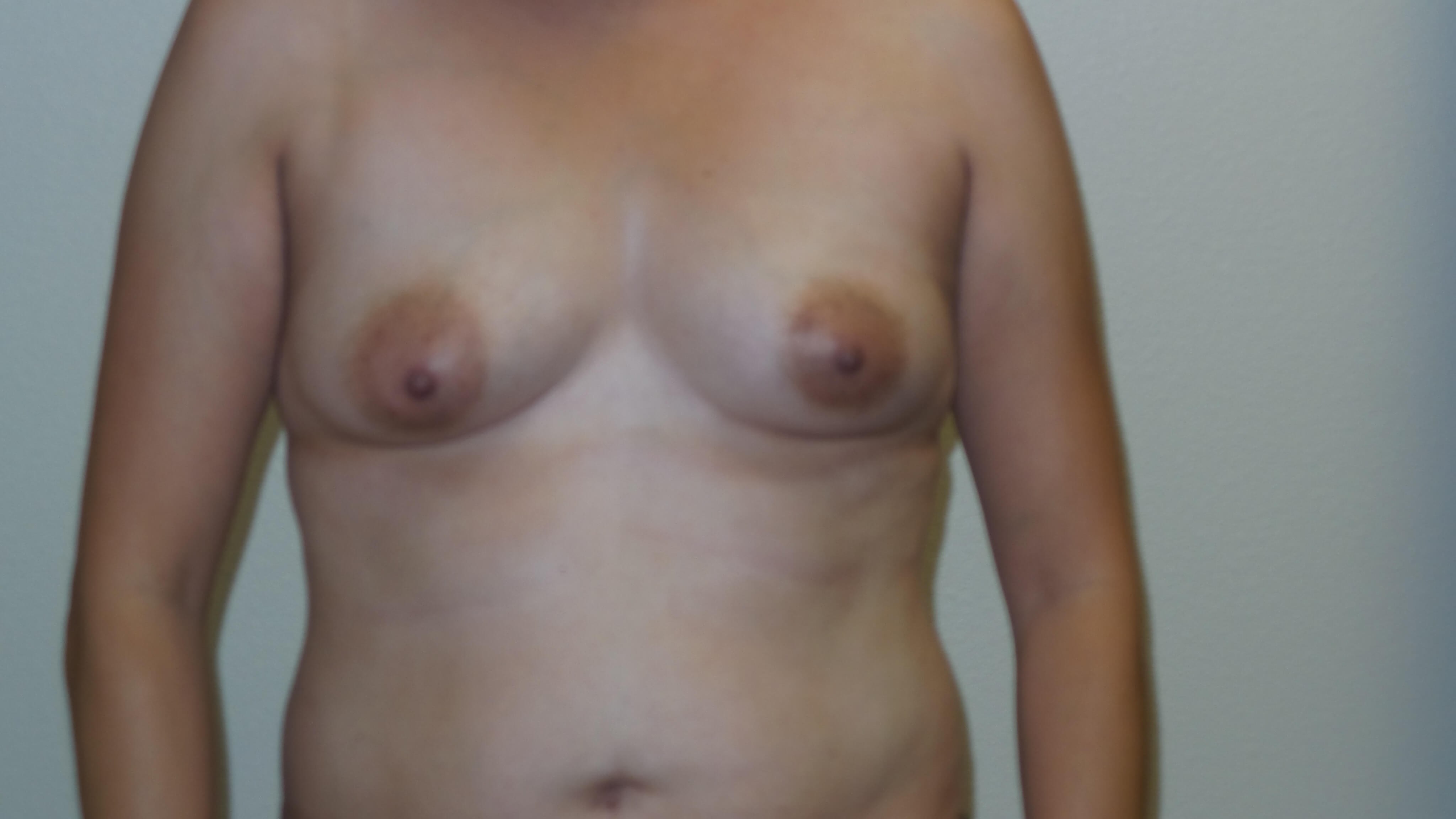 Woman has Mommy Makeover Before