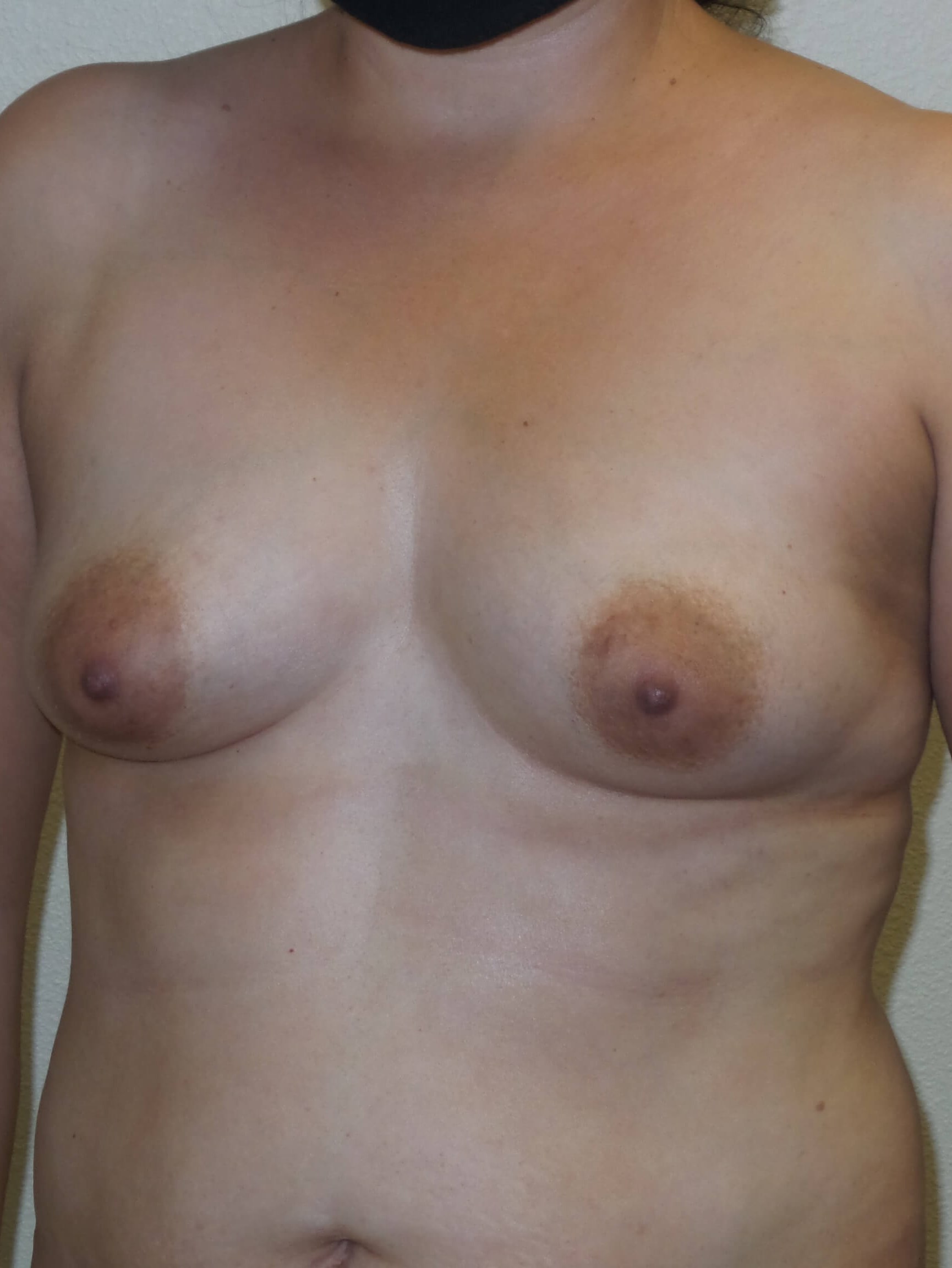 Woman has Mommy Makeover Before