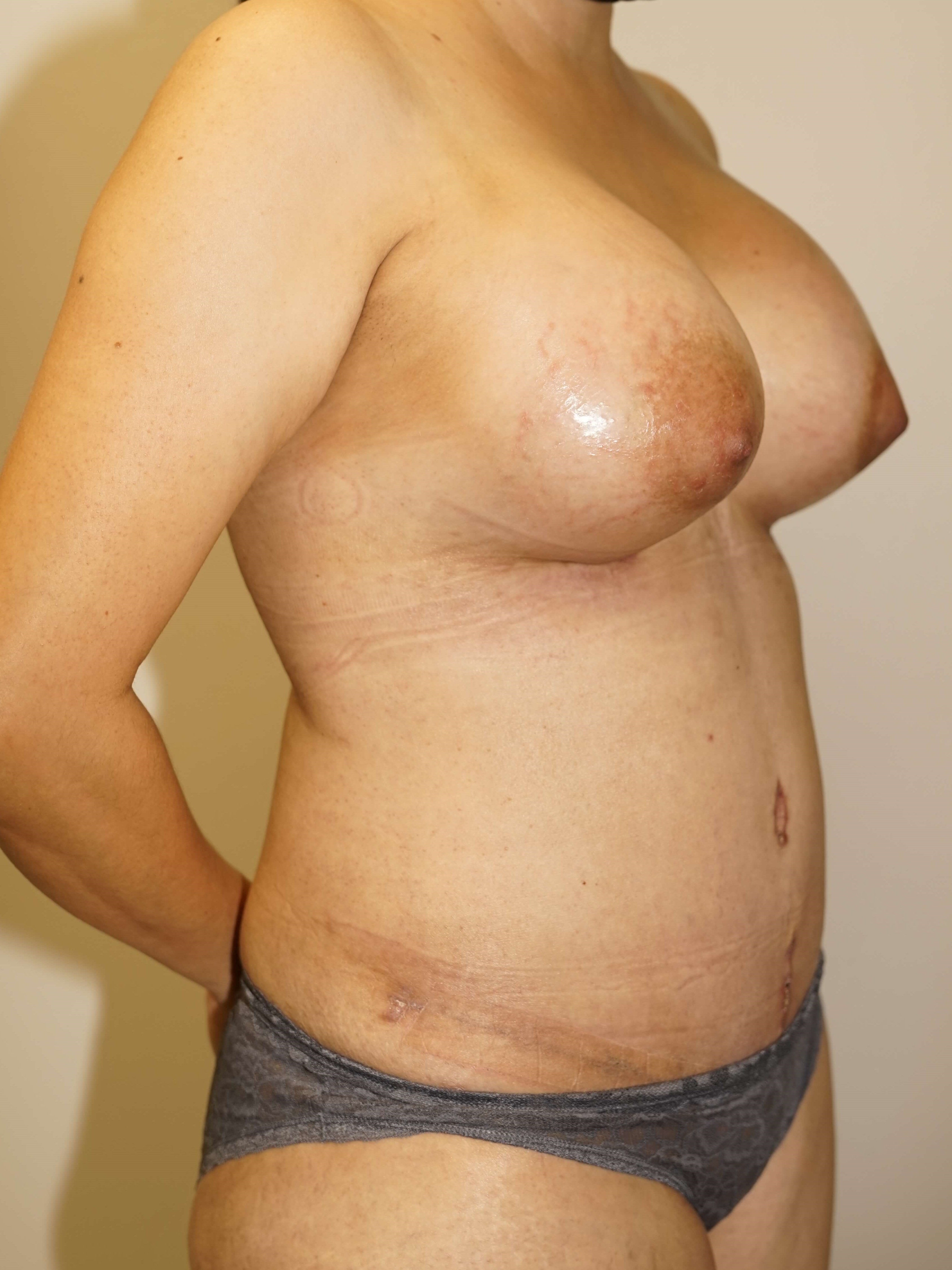 Woman has Mommy Makeover After