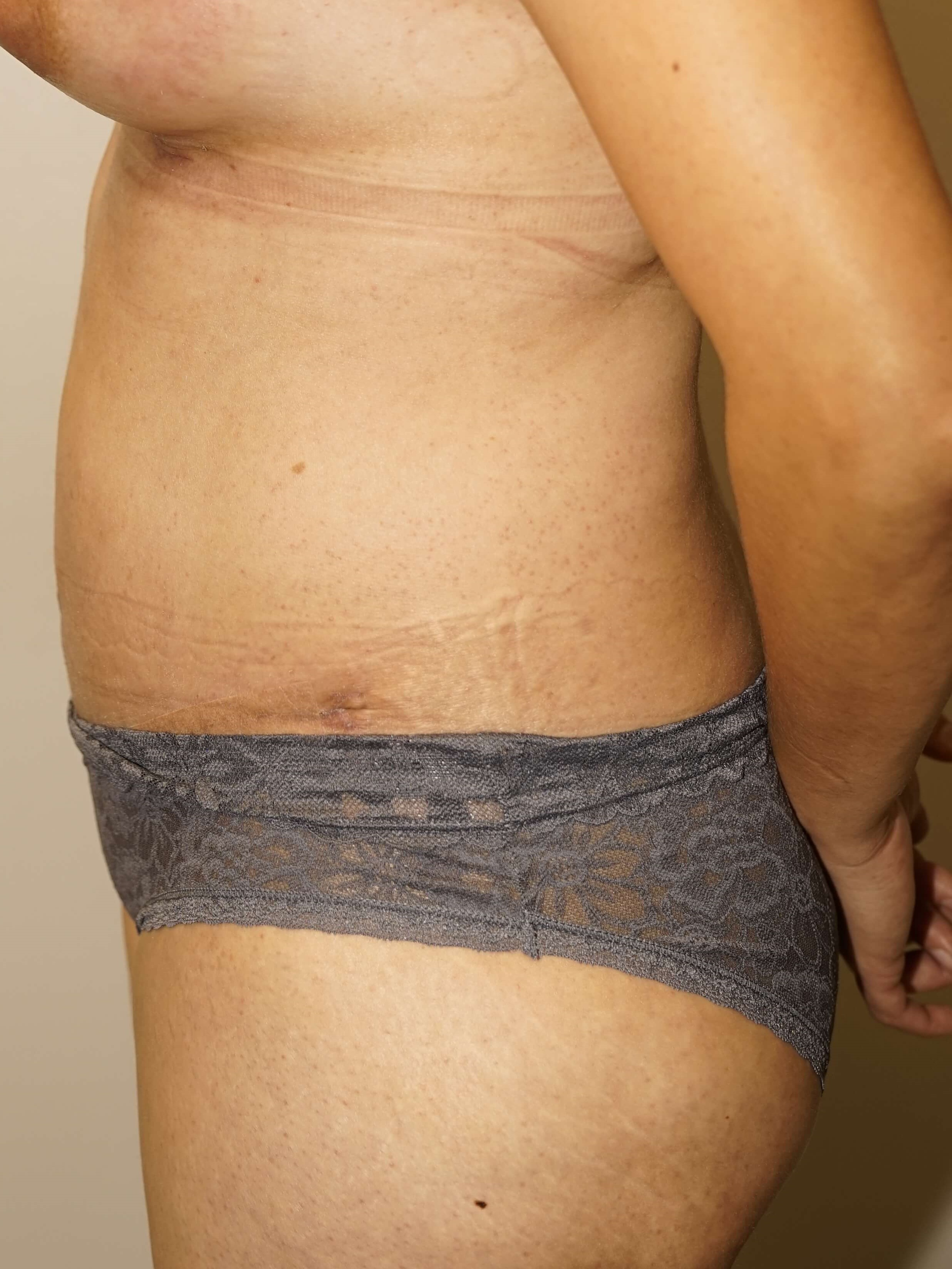 Woman has Mommy Makeover After