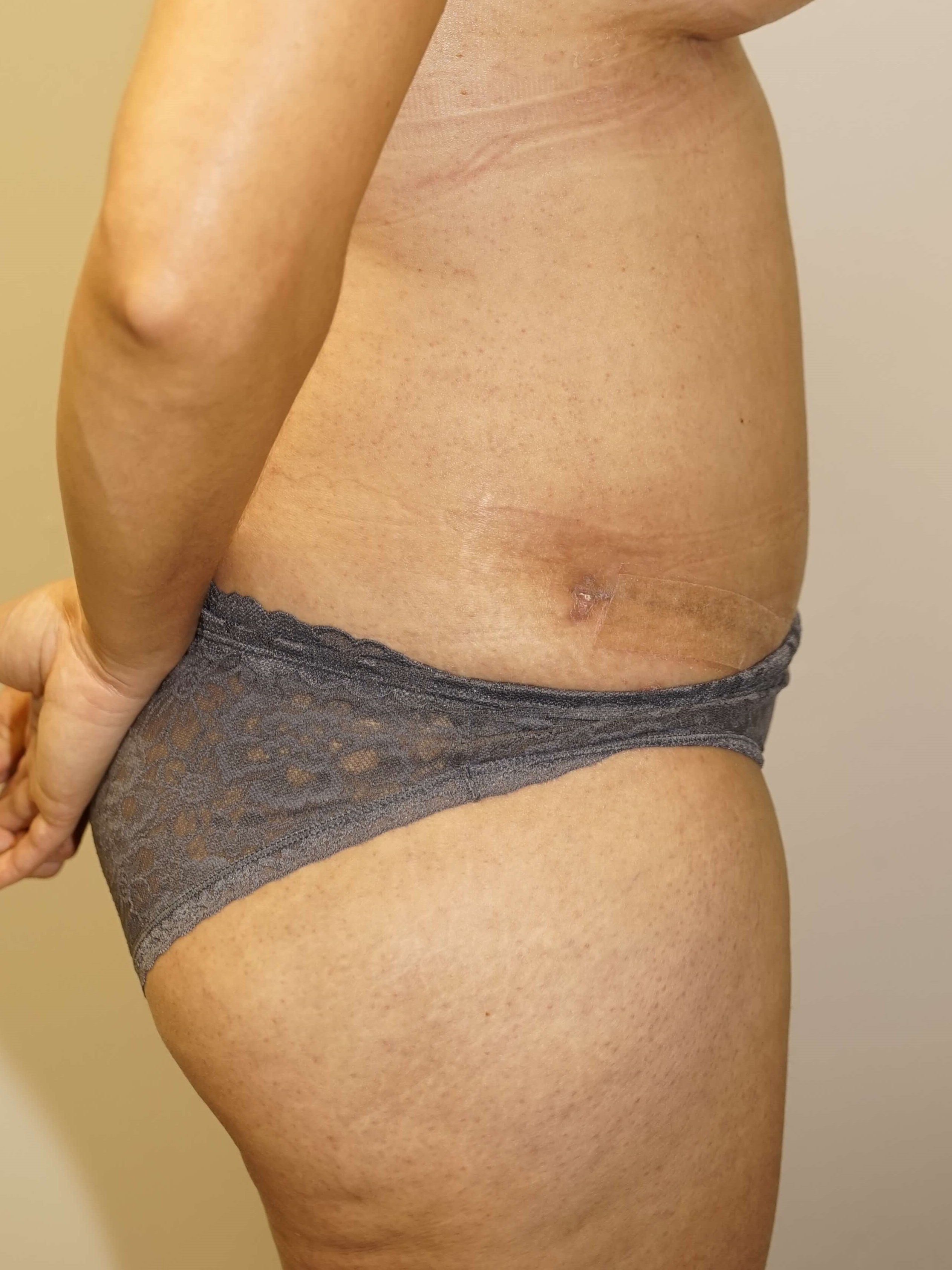 Woman has Mommy Makeover After