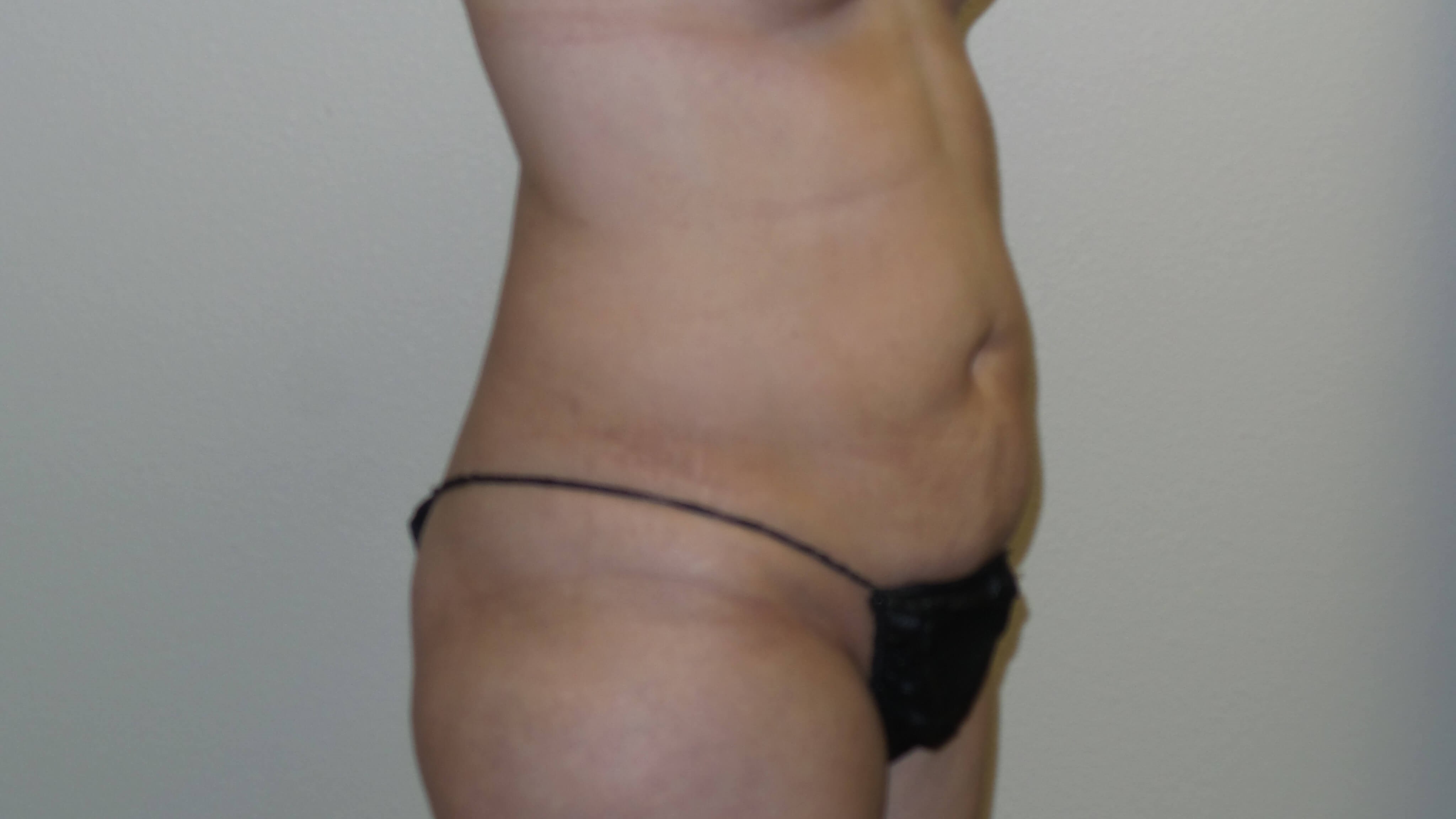Woman has Mommy Makeover Before
