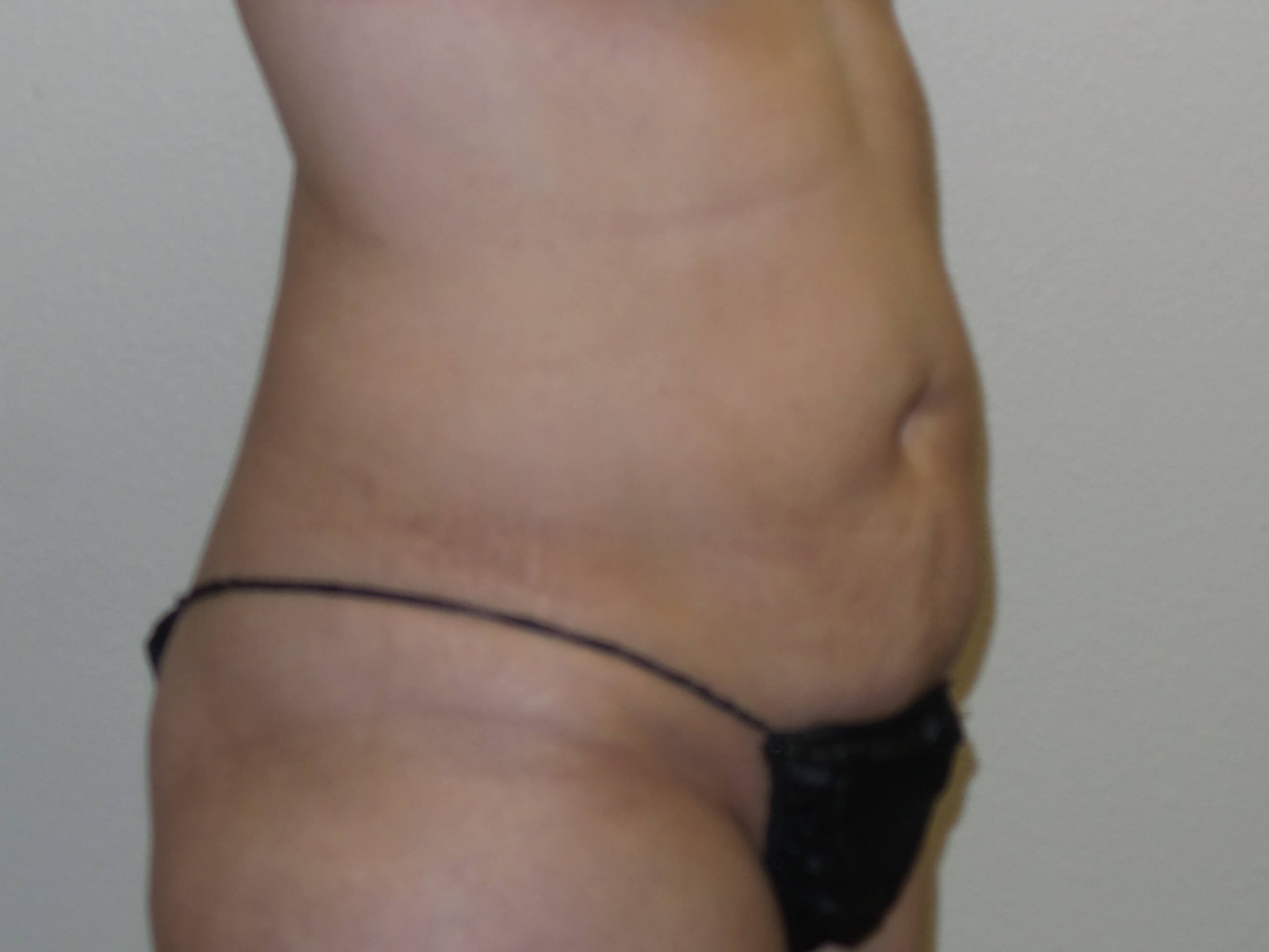 Woman has Mommy Makeover Before
