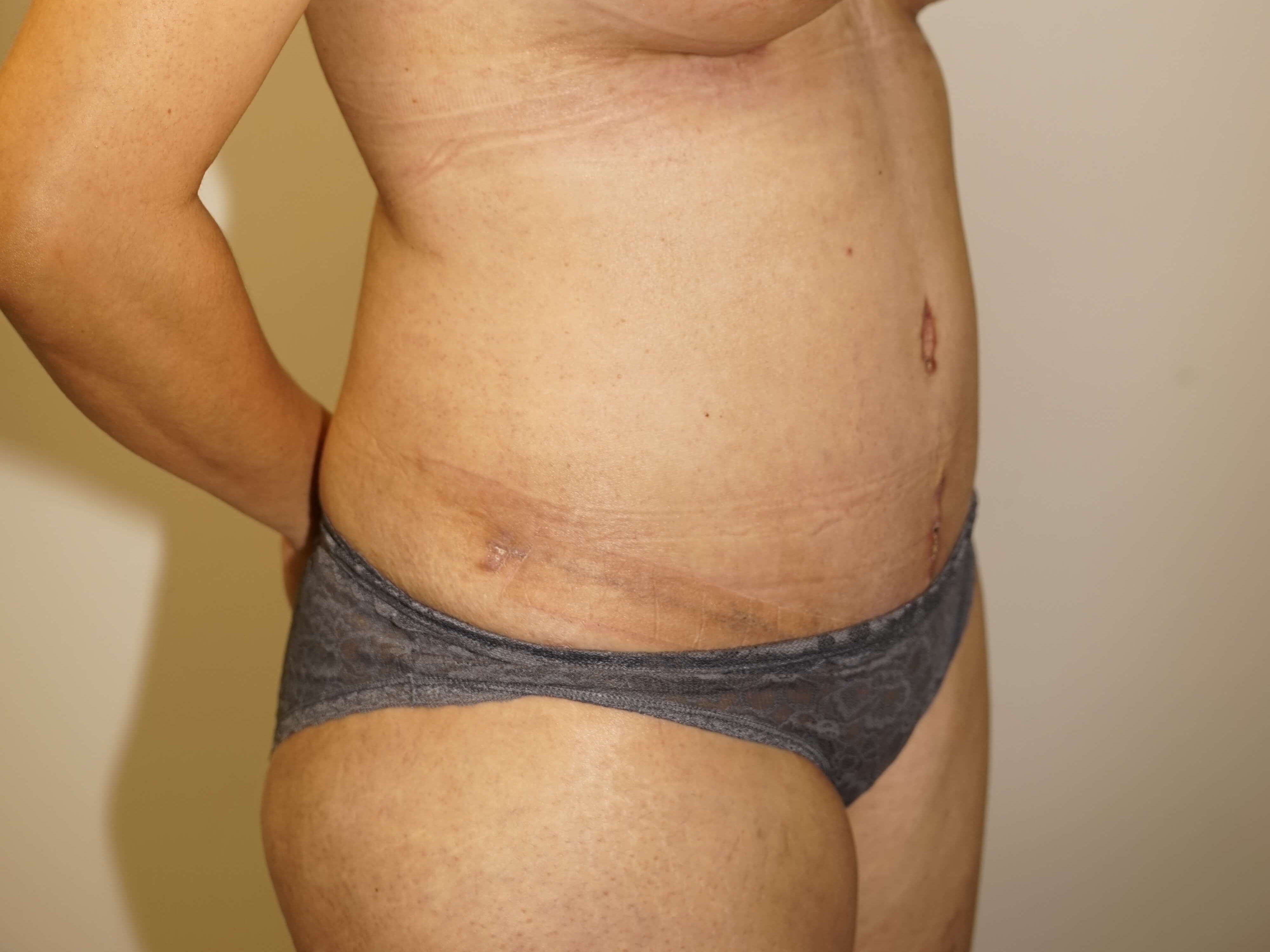 Woman has Mommy Makeover After