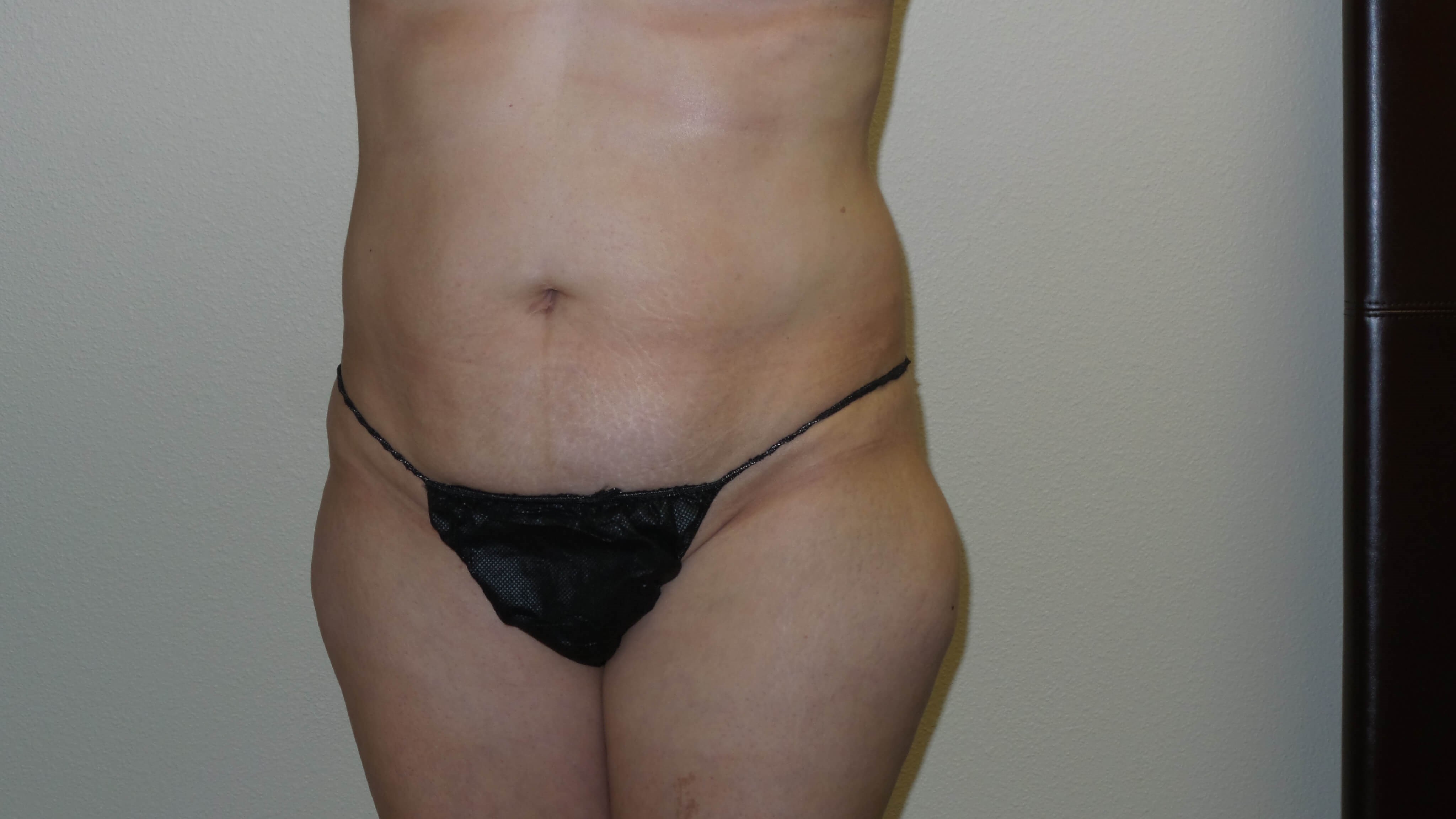 Woman has Mommy Makeover Before