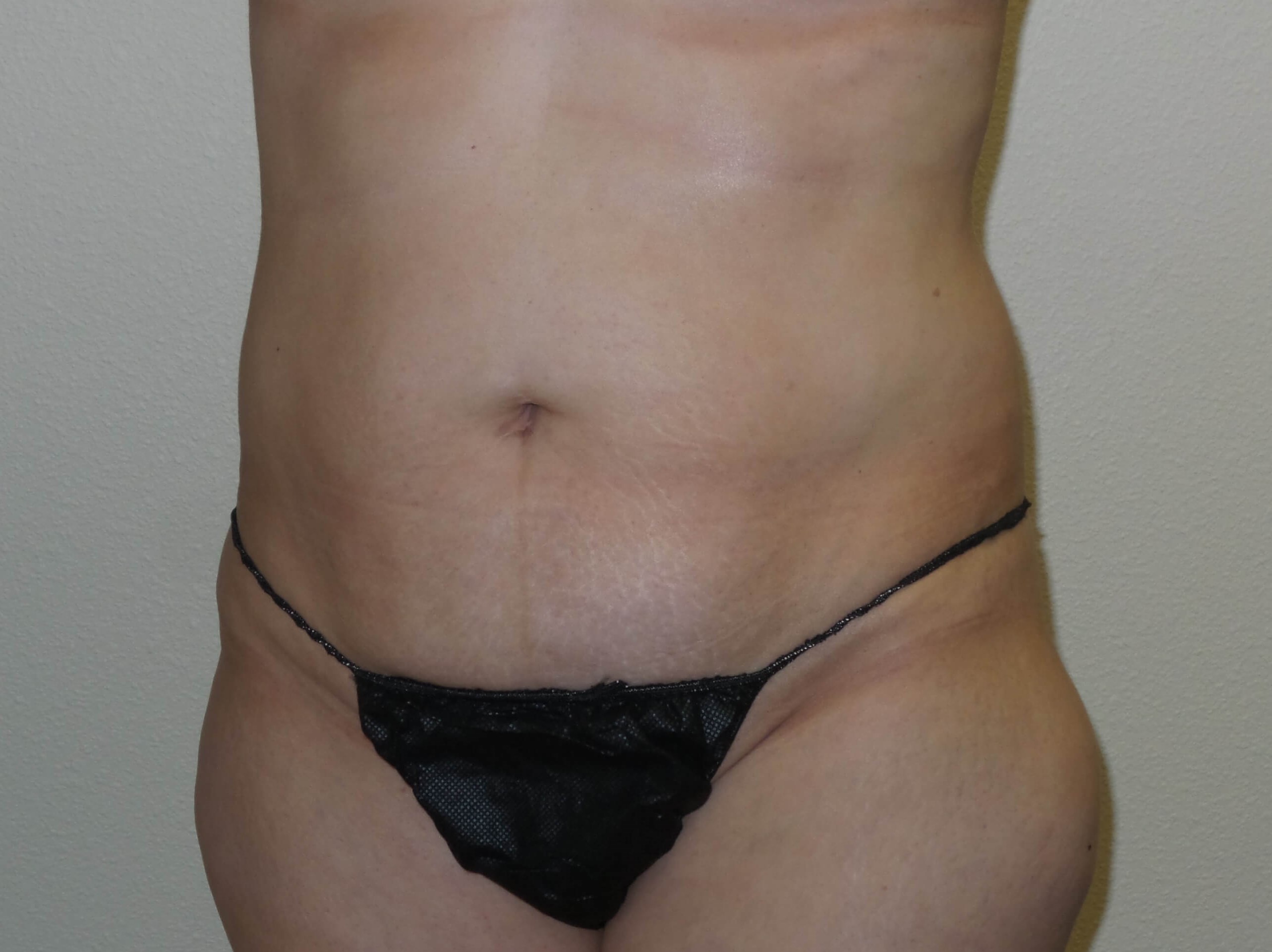 Woman has Mommy Makeover Before