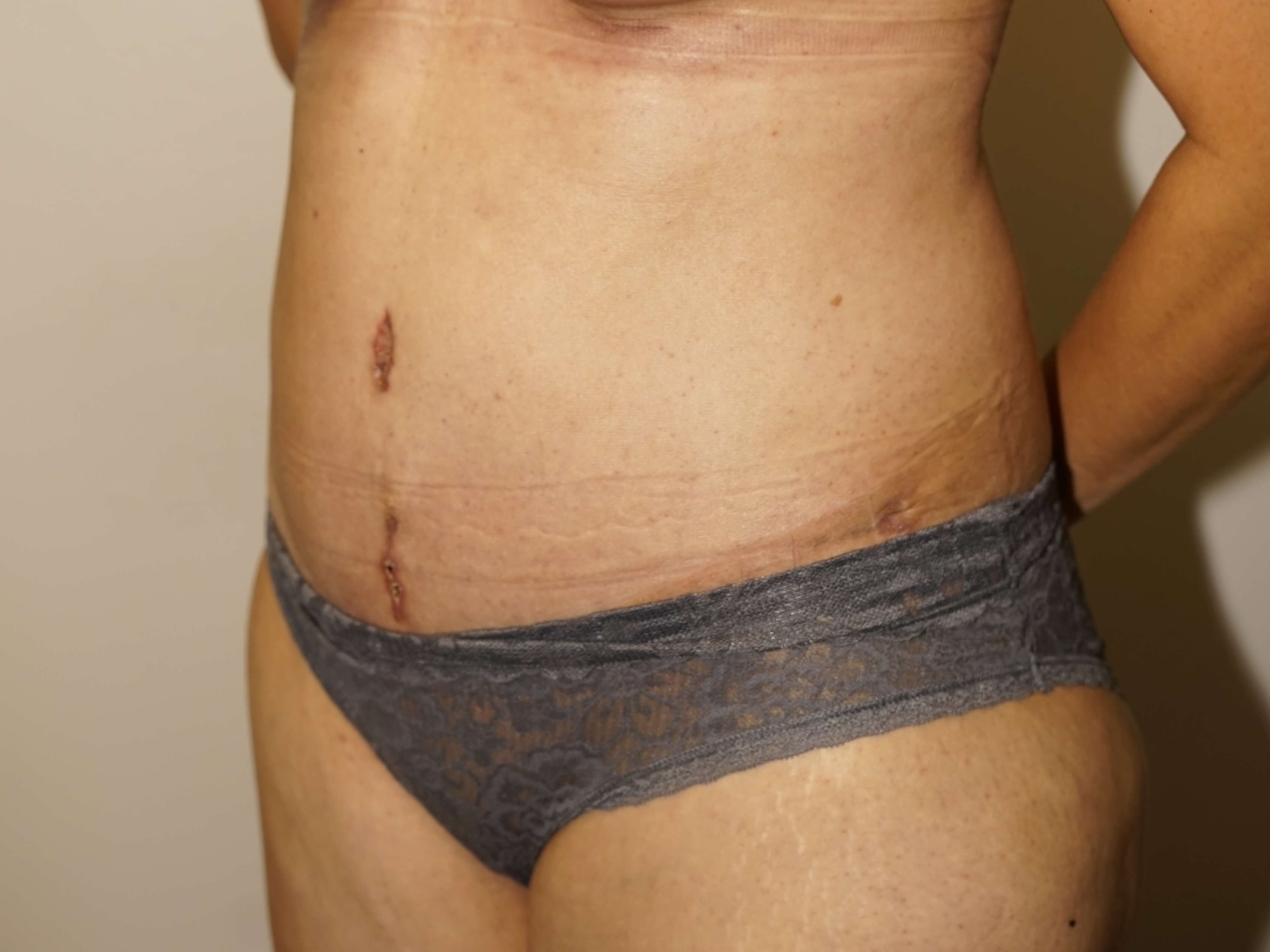 Woman has Mommy Makeover After