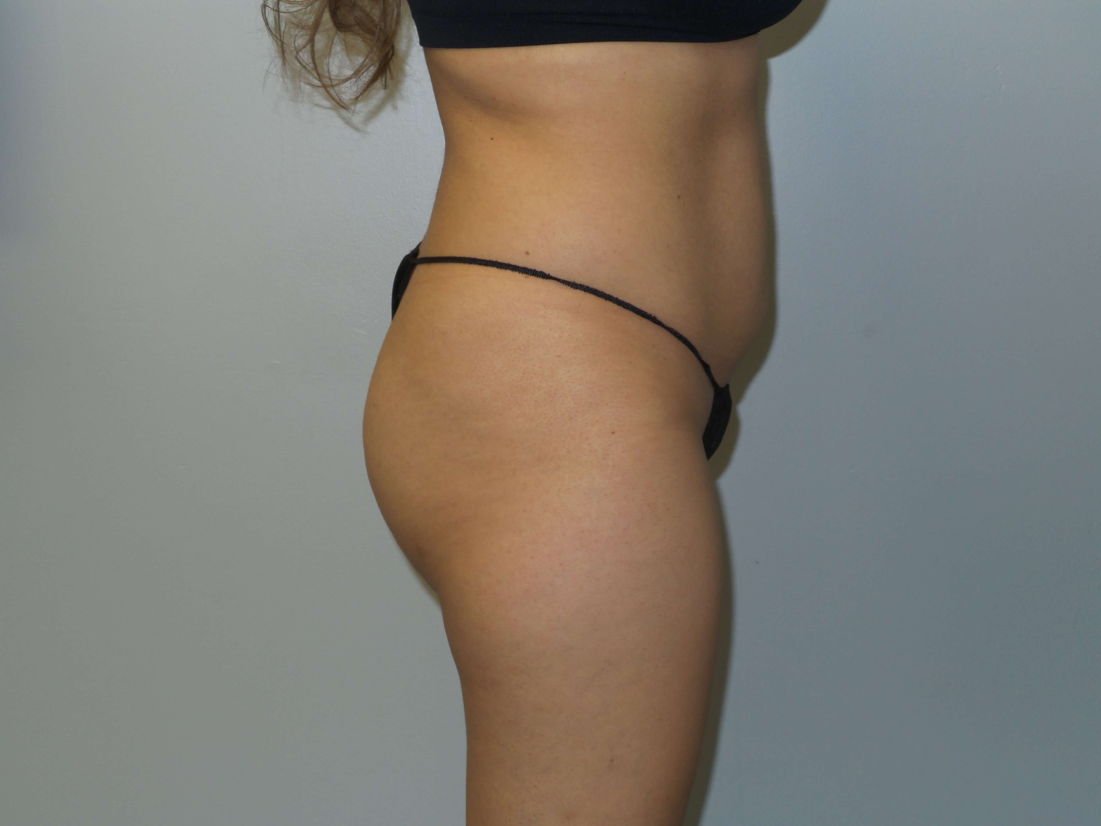 Woman has Butt Lift Before