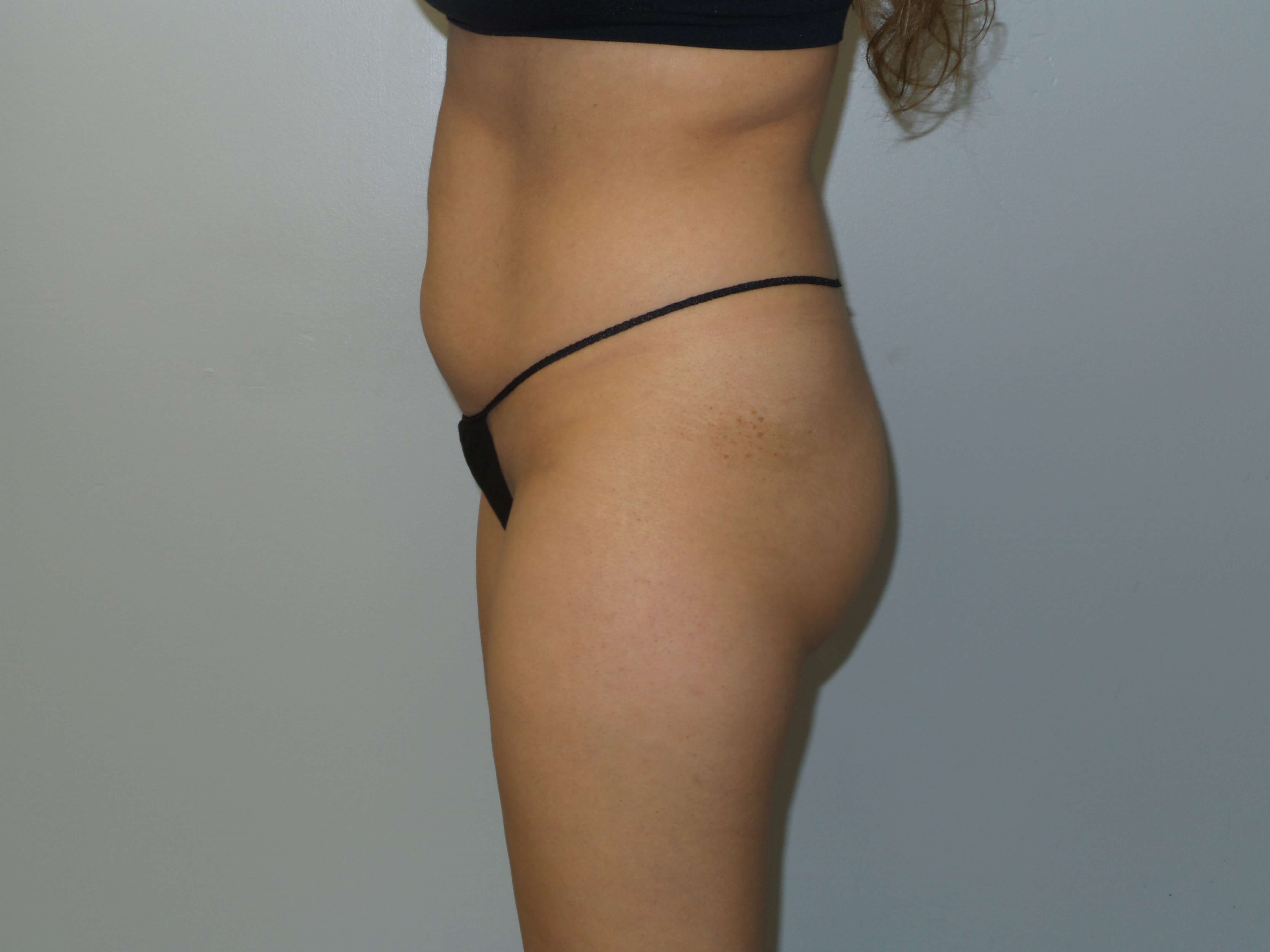 Woman has Butt Lift Before