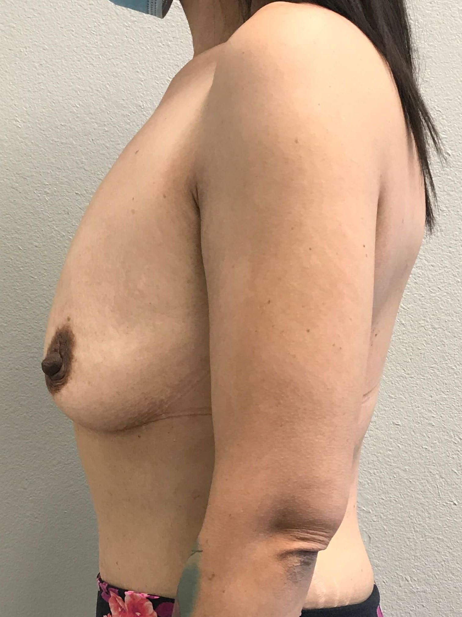 Westlake Woman Has Breast Aug Before