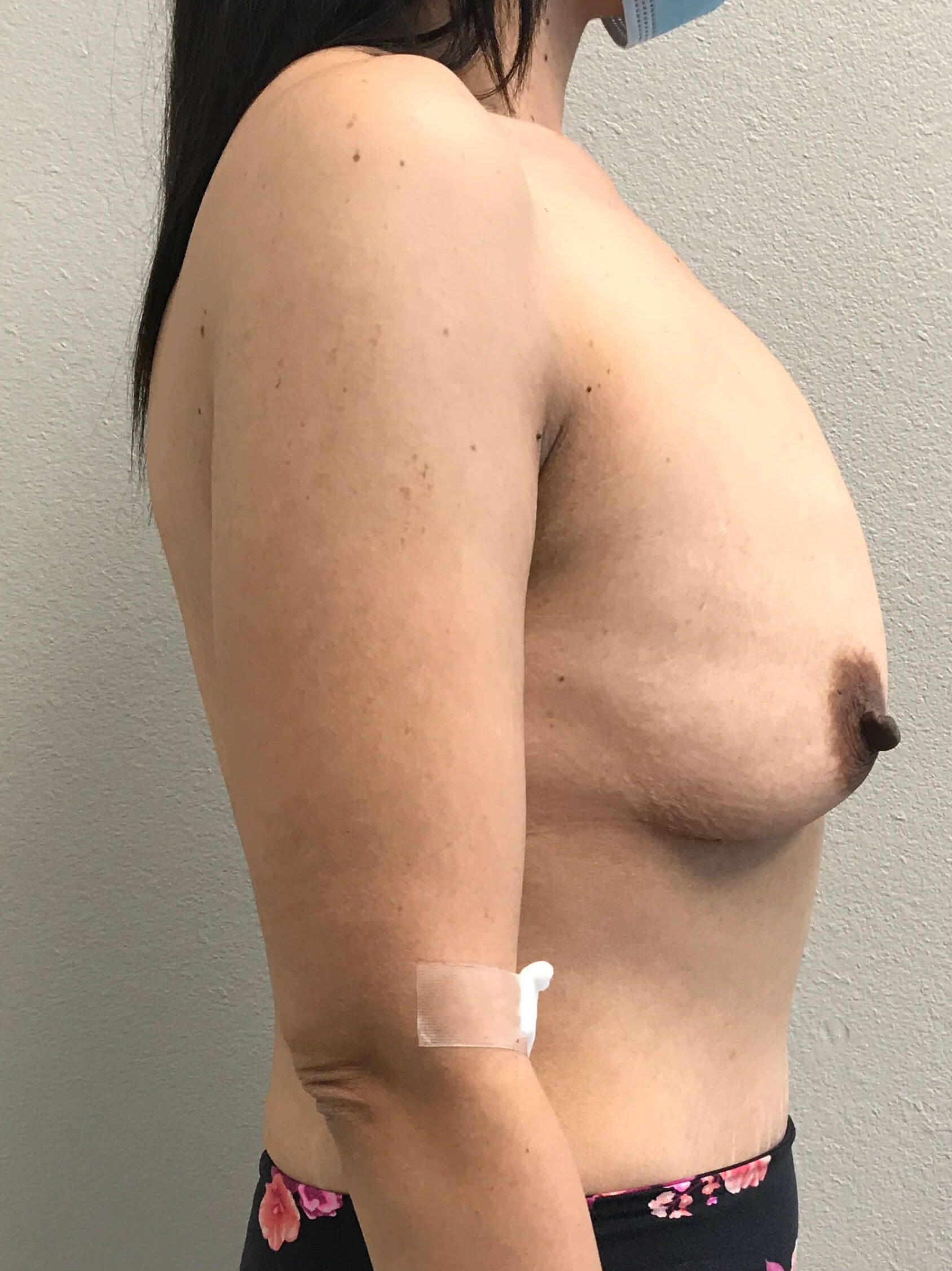 Westlake Woman Has Breast Aug Before