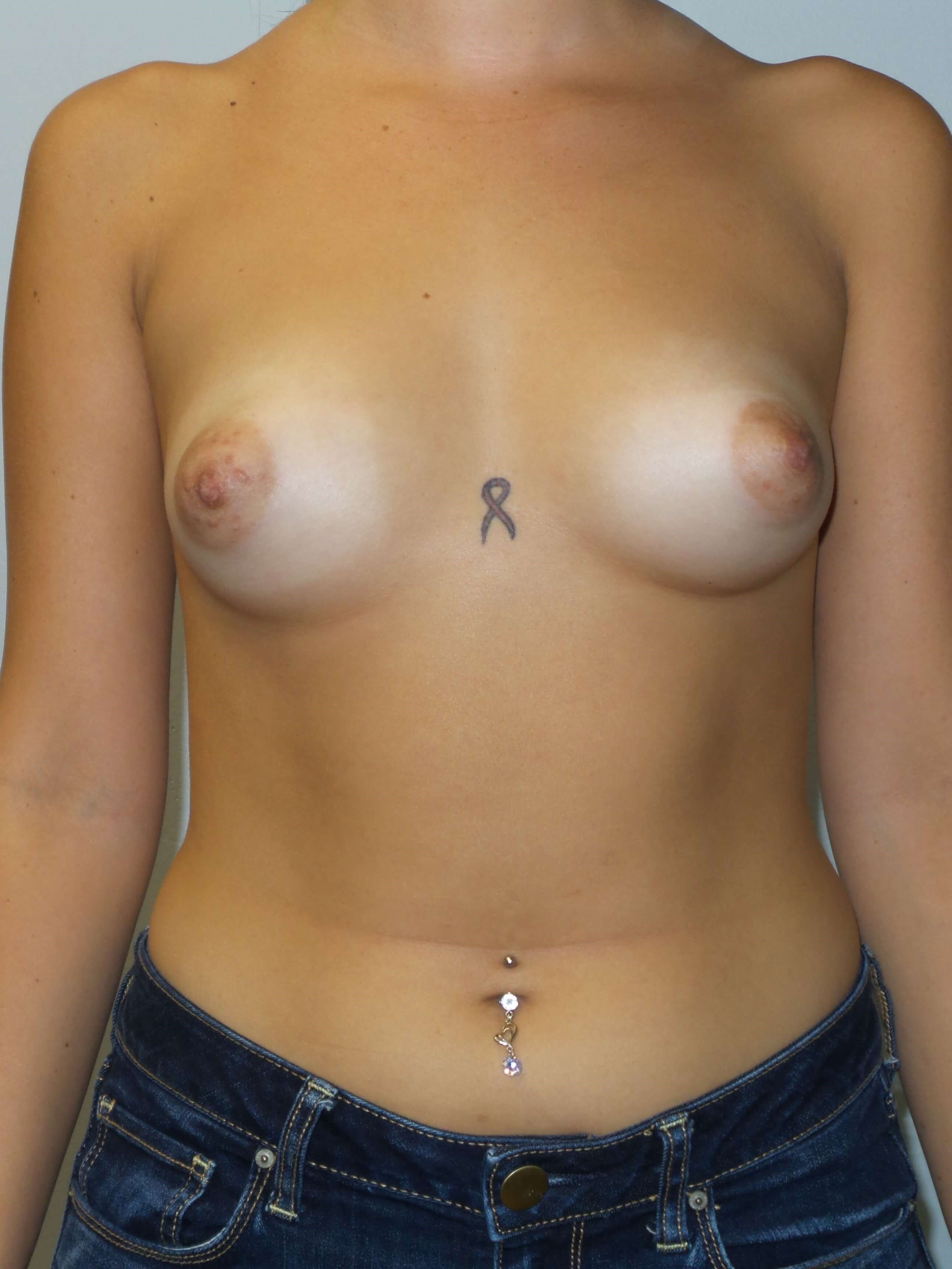 Westlake Woman Has Breast Aug Before