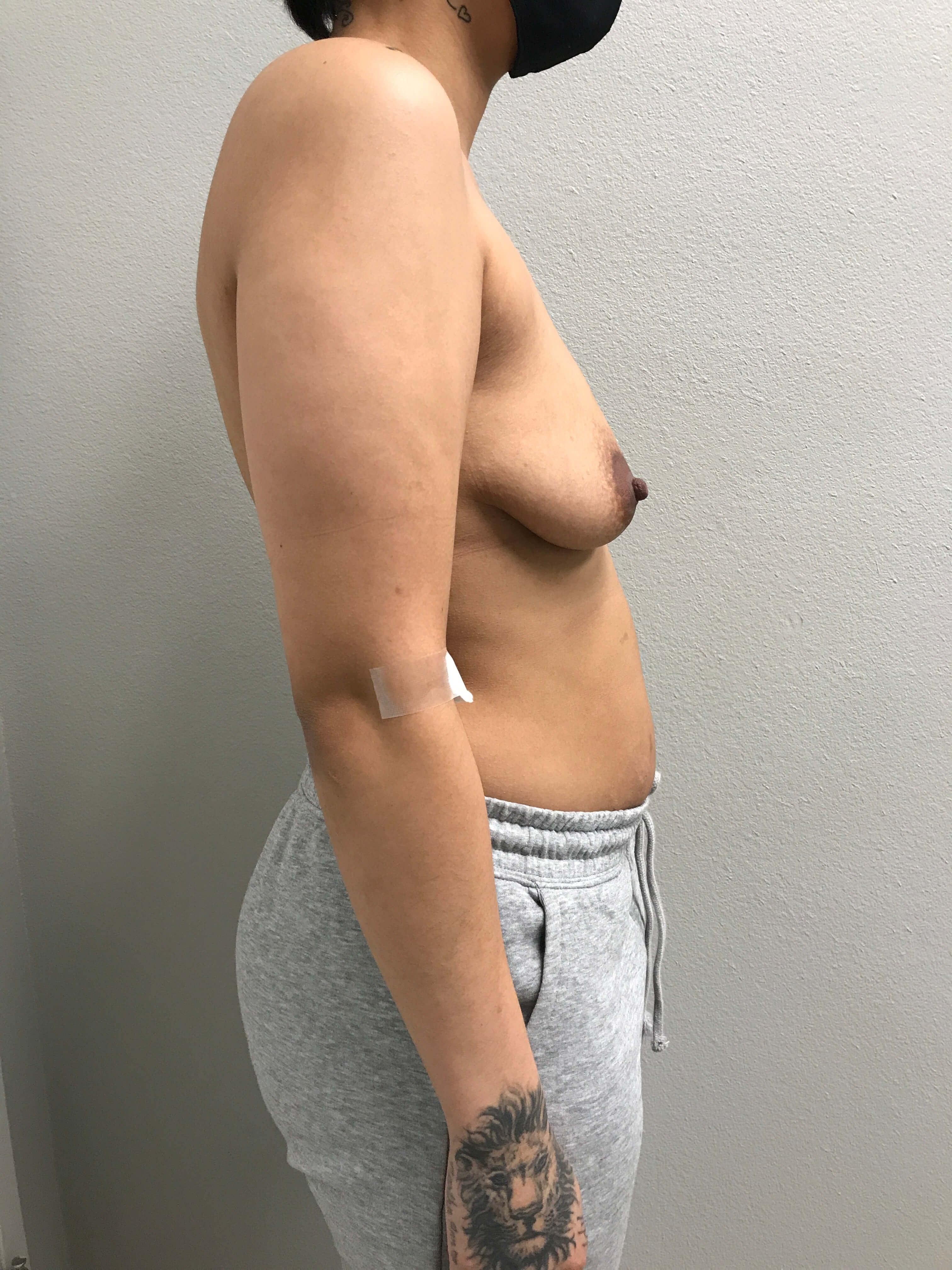 Westlake Woman Has Breast Aug Before