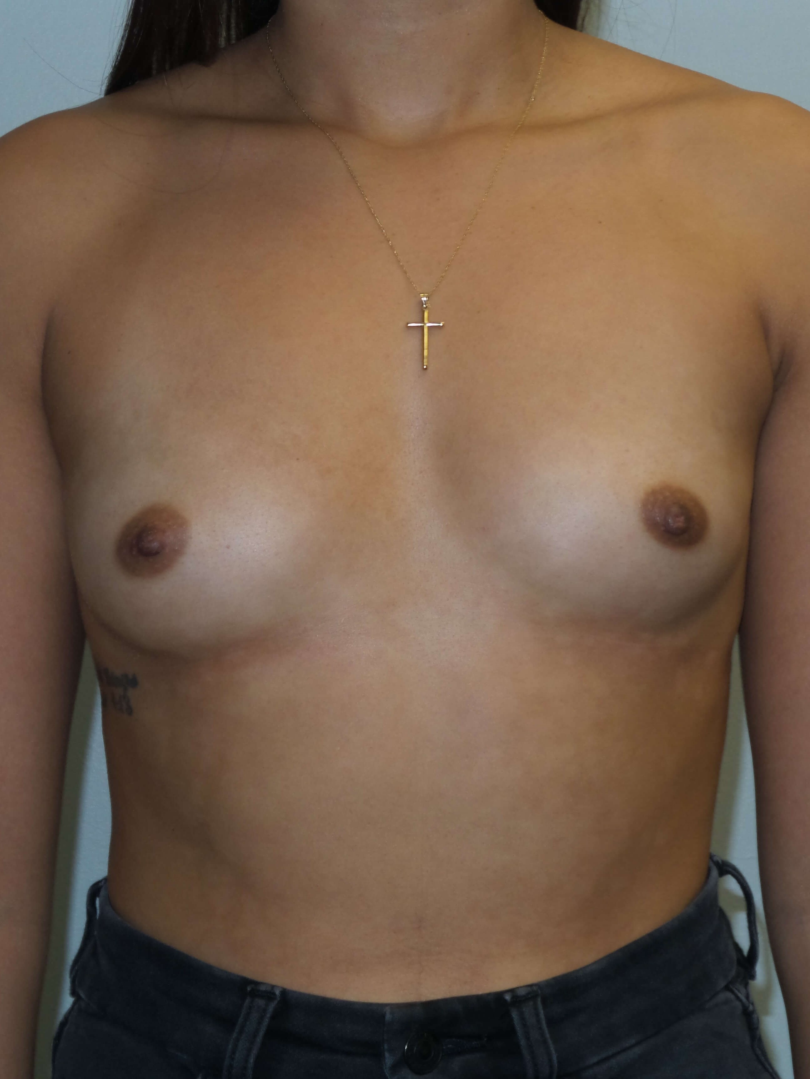 Westlake Woman Has Breast Aug Before