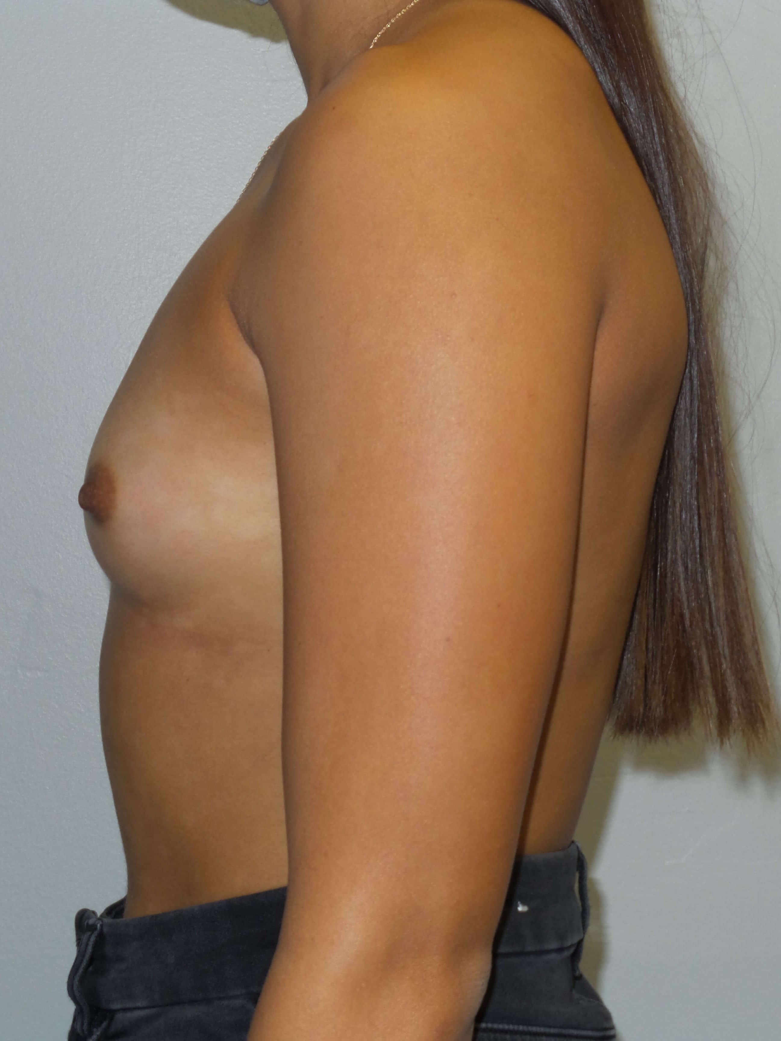 Westlake Woman Has Breast Aug Before