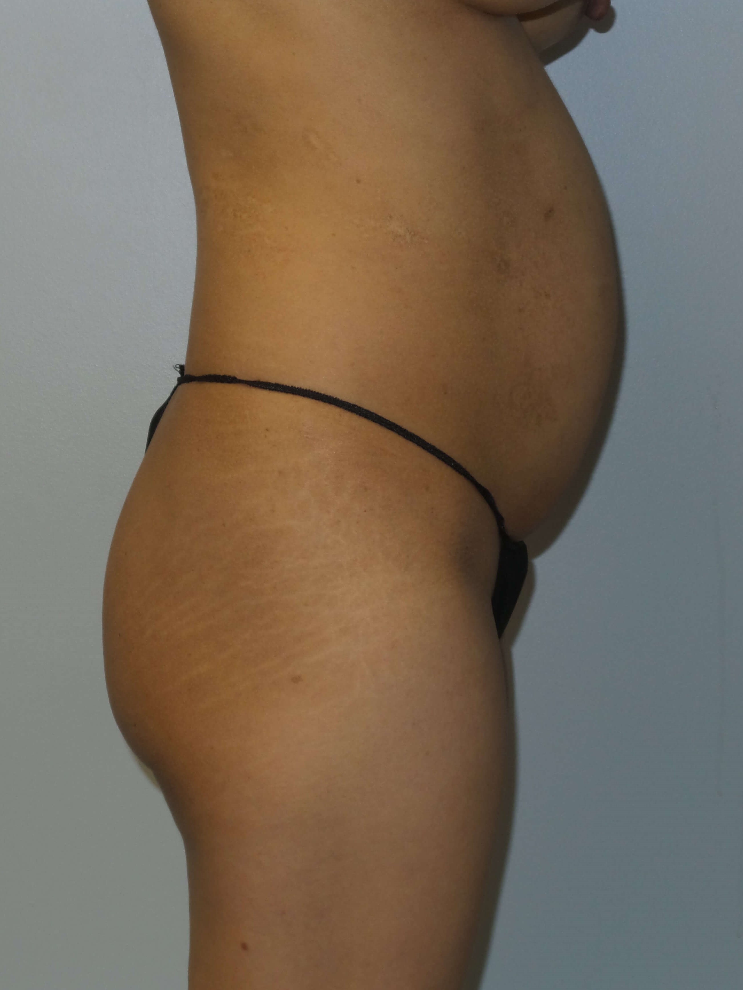 Westlake Woman Has Butt Lift Before