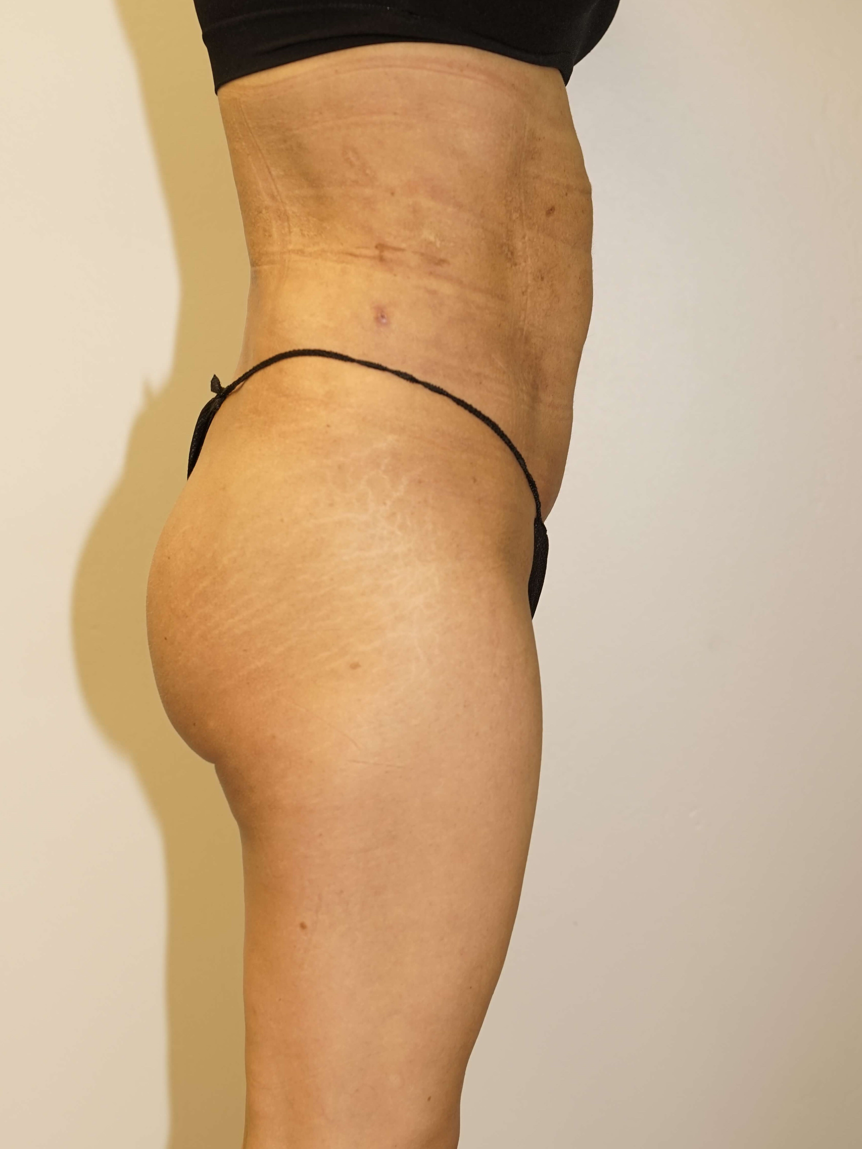 Westlake Woman Has Butt Lift After